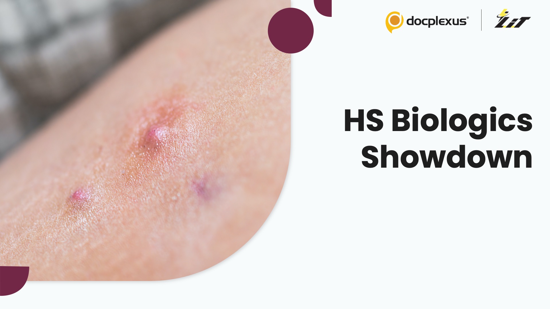 Biologics in Hidradenitis Suppurativa: What Phase III Data Really Show