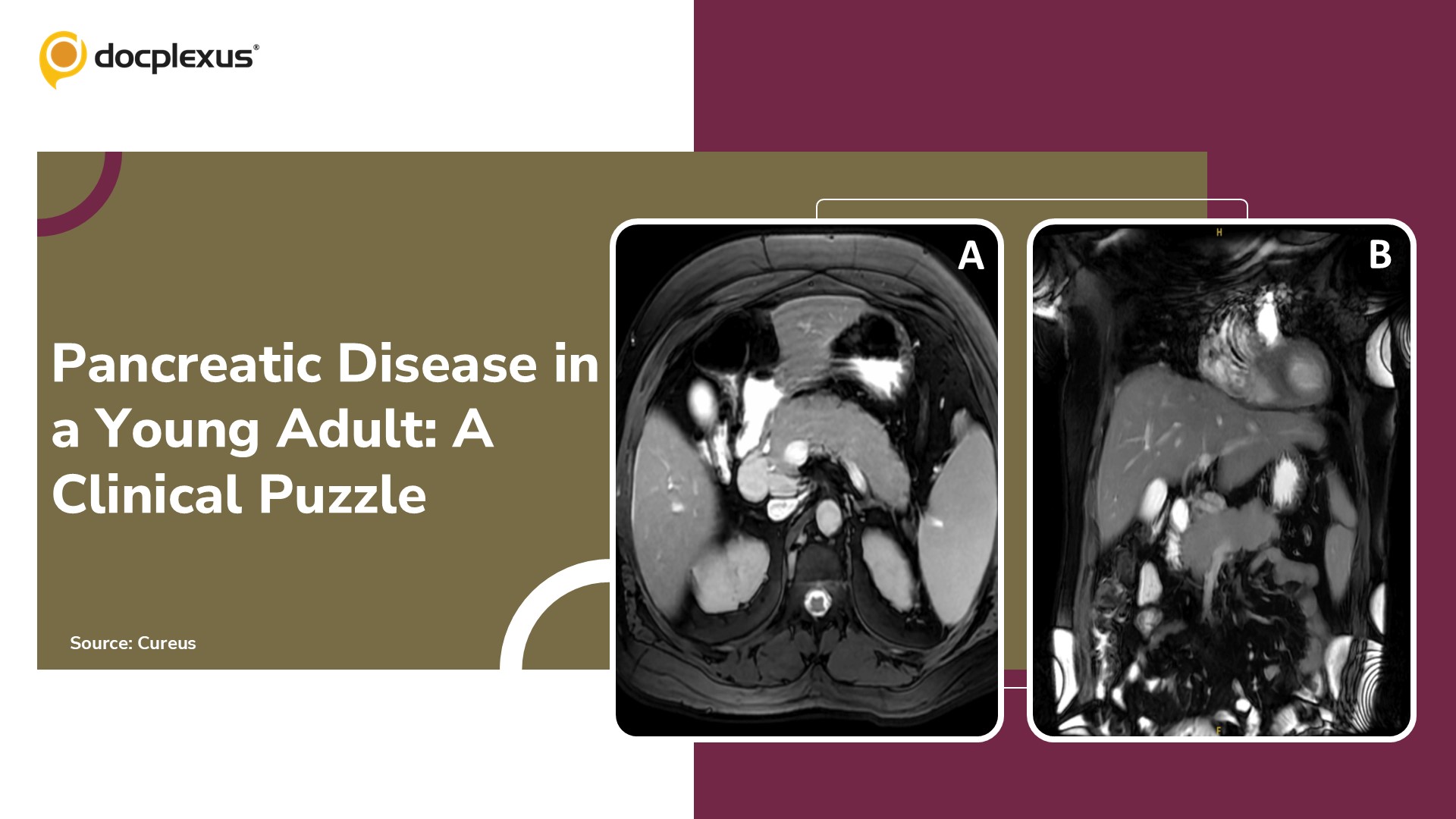 A Young Adult Male with Pancreatic Disease: A Diagnostic Dilemma
