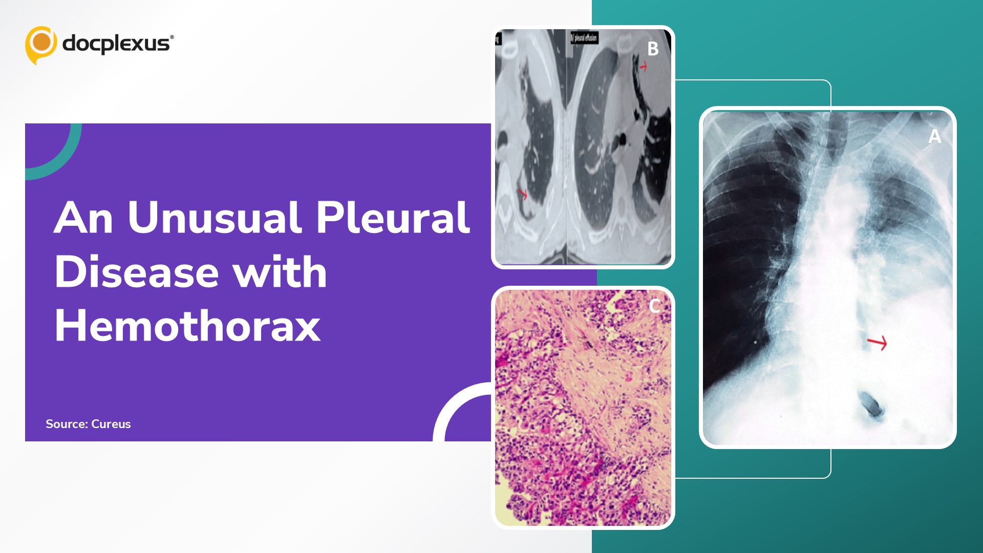 An Unusual Case of Pleural Disease Presenting with Hemothorax