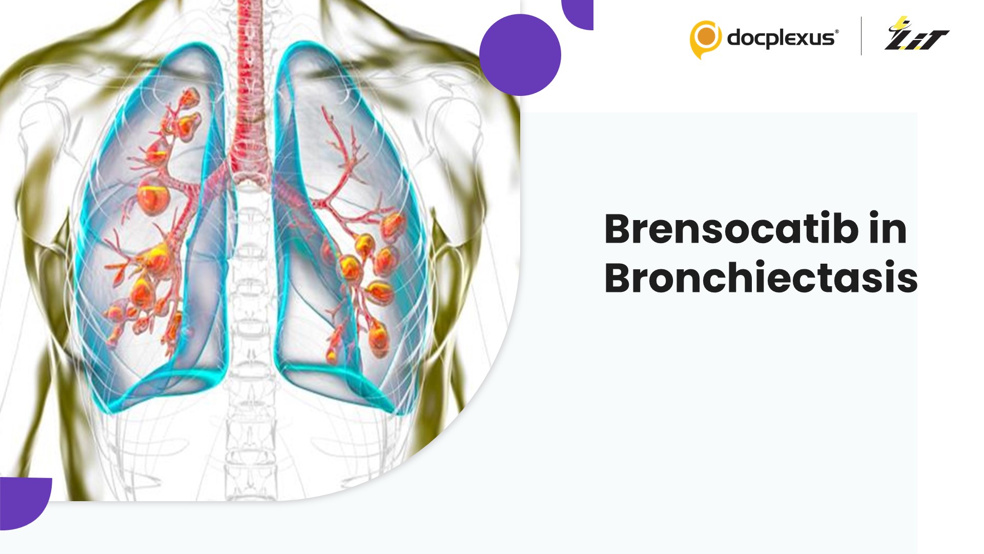 Brensocatib for Bronchiectasis: Efficacy and Safety Overview