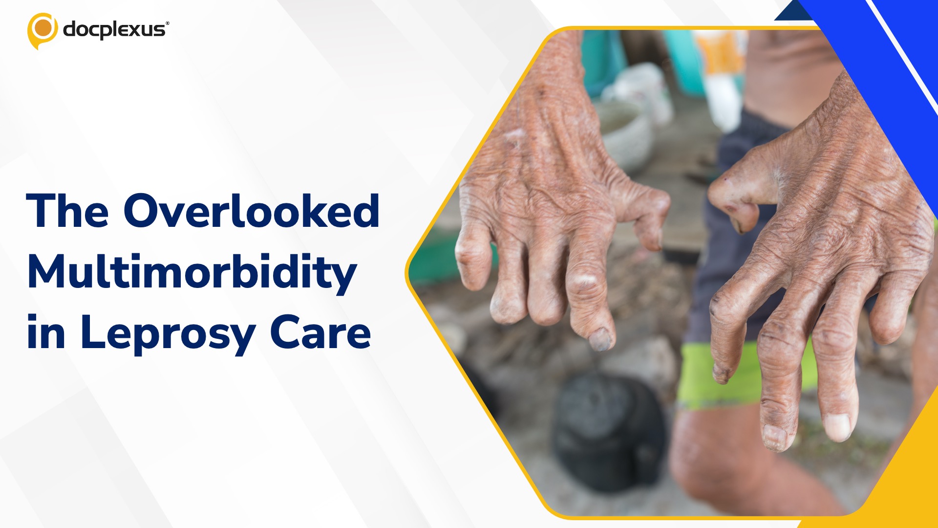 Indian Study Highlights Hidden Burden of Multimorbidity in Leprosy Care