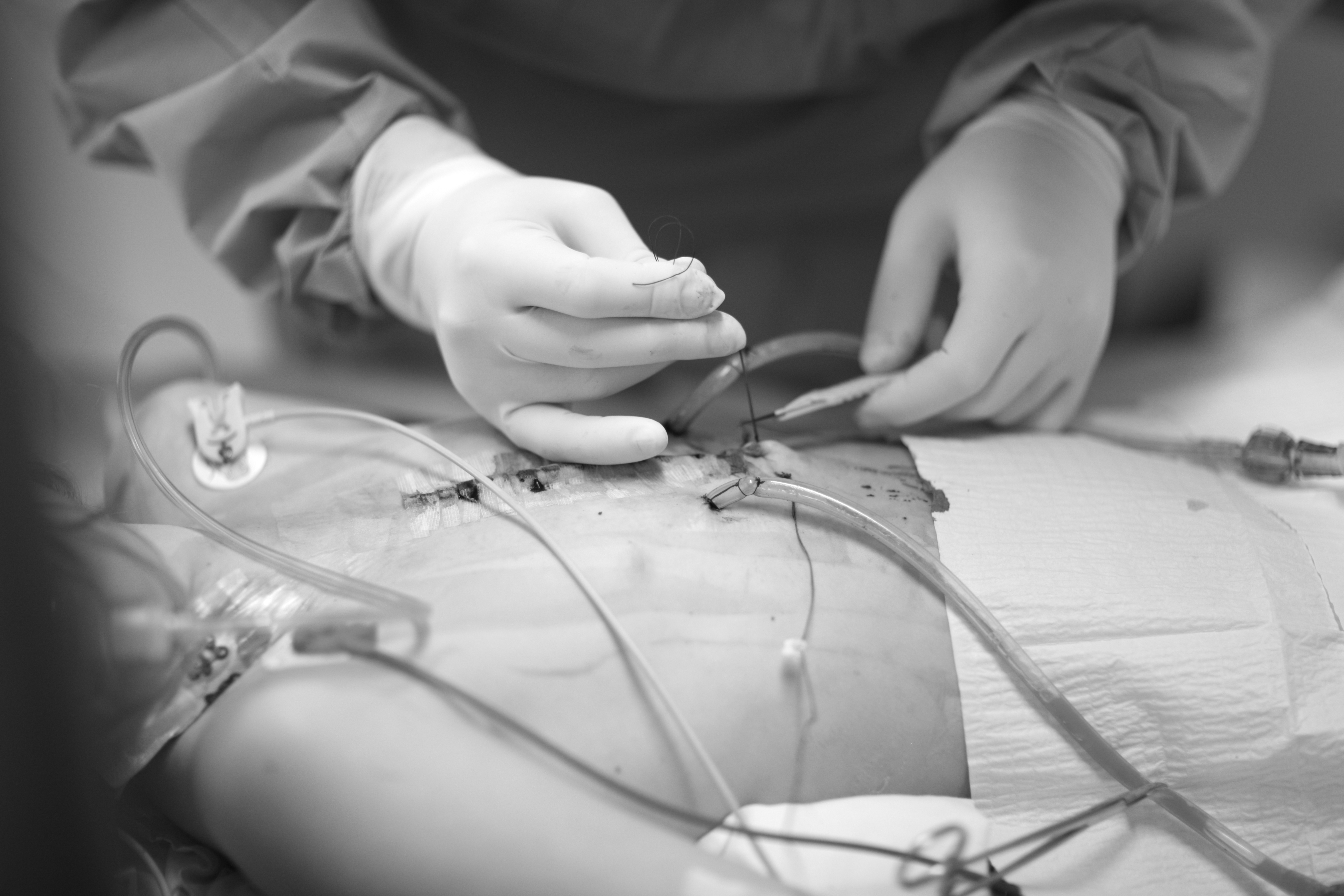 Syringe Suction Drain: An Effective Alternative In Resource-limited Settings 