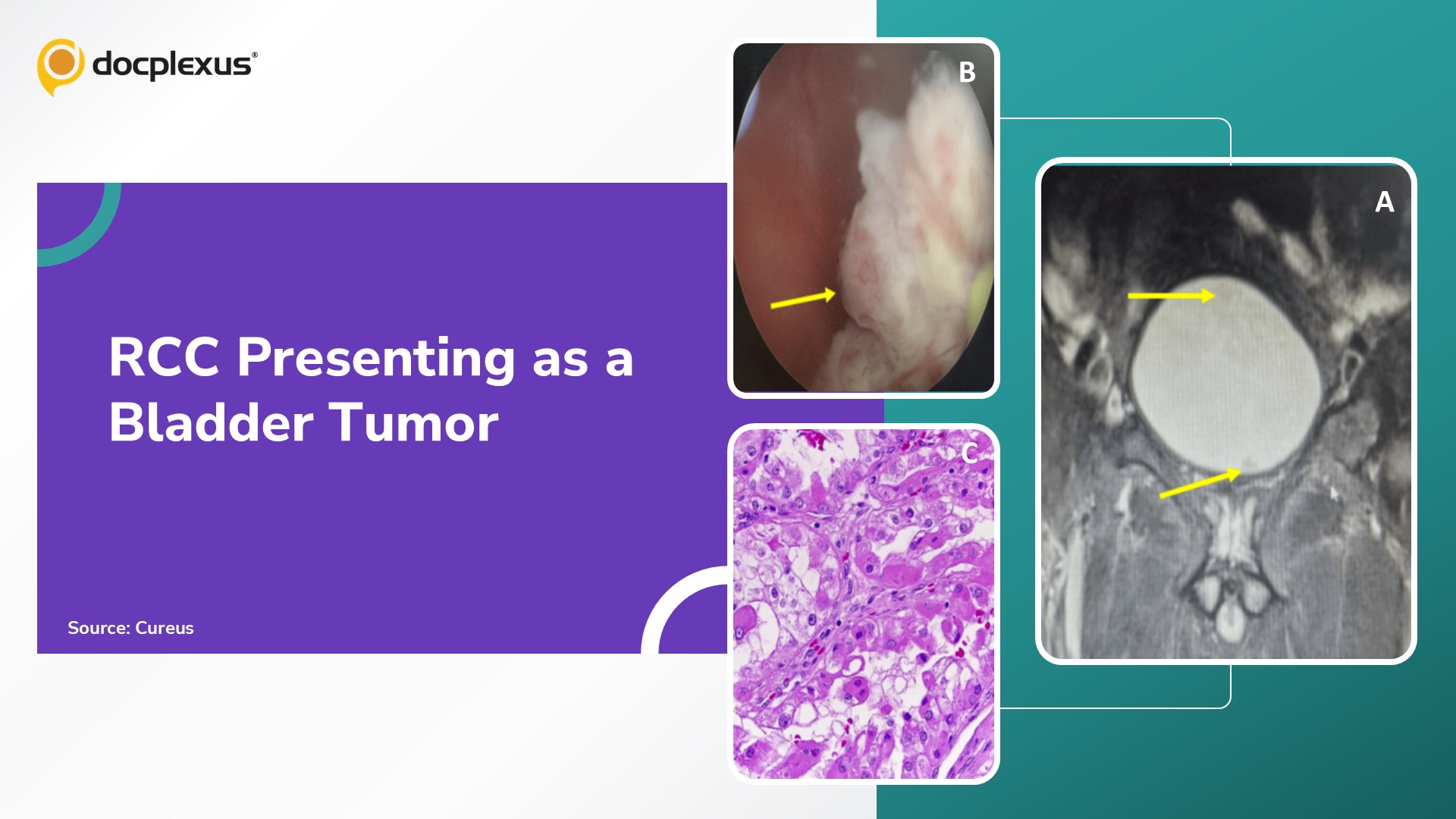 A Renal Cell Carcinoma Metastasis Mimicking a Bladder Tumor
