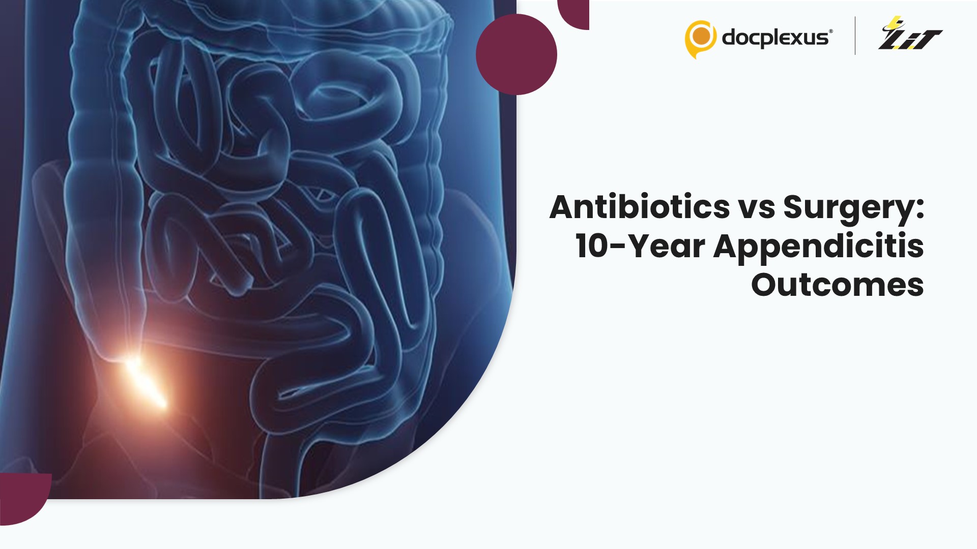 Antibiotics vs Appendectomy in Uncomplicated Acute Appendicitis