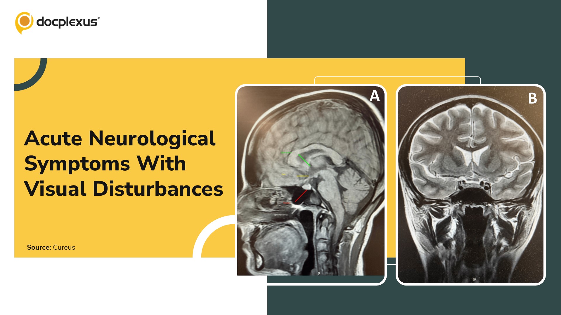 A Case of Acute Neurological Symptoms With Transient Visual Disturbances