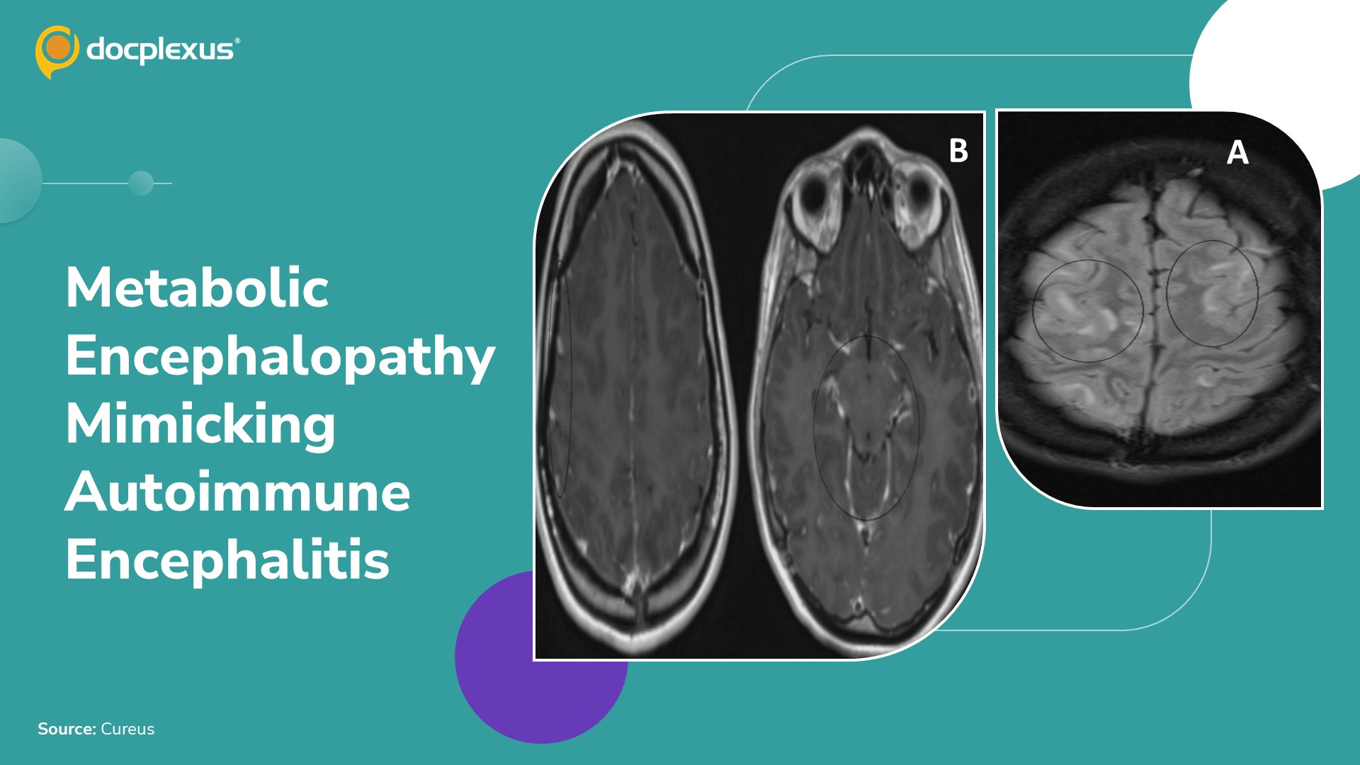 A Rare Metabolic Disorder Mimicking Autoimmune Encephalitis: A Diagnostic Challenge