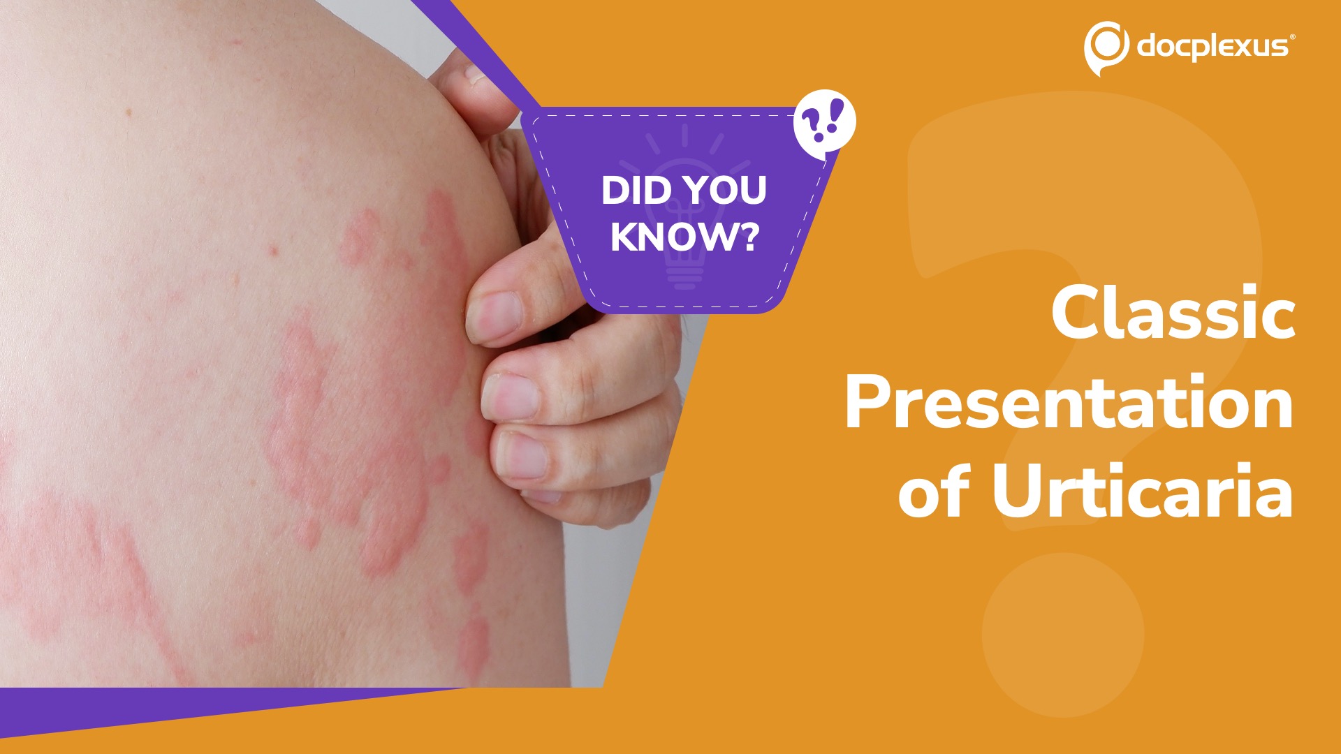 Can You Spot the Classic Presentation of Urticaria?