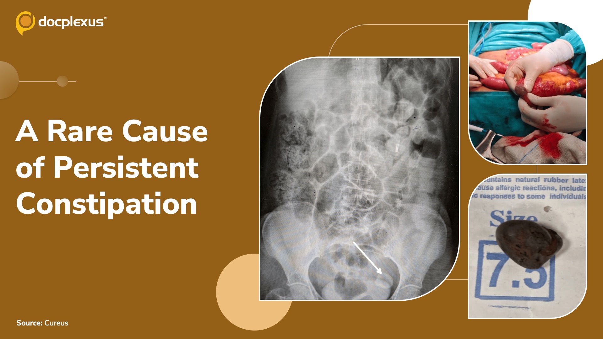 When Constipation Turns Critical: An Unusual Cause of Small Bowel Obstruction