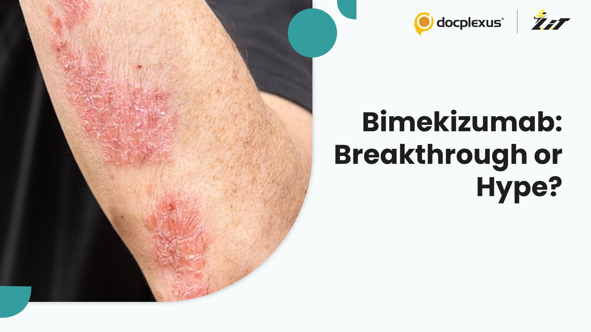 Bimekizumab in Psoriasis: Major Advance or Marginal Benefit?