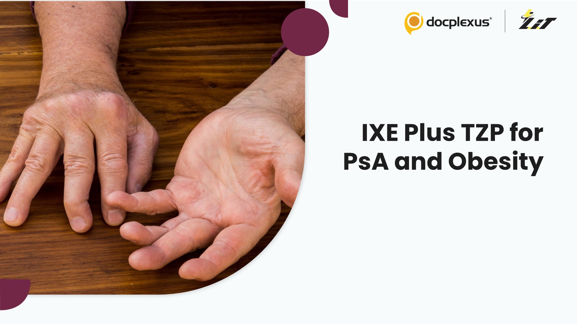 Ixekizumab Plus Tirzepatide for Psoriatic Arthritis and Obesity