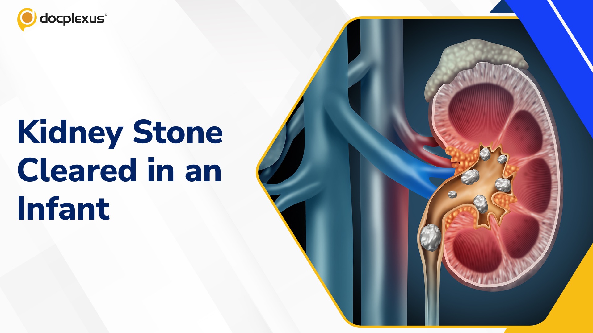 Tiny Patient, Big Win: Kidney Stone Cleared Without Surgery in a One-Year-Old