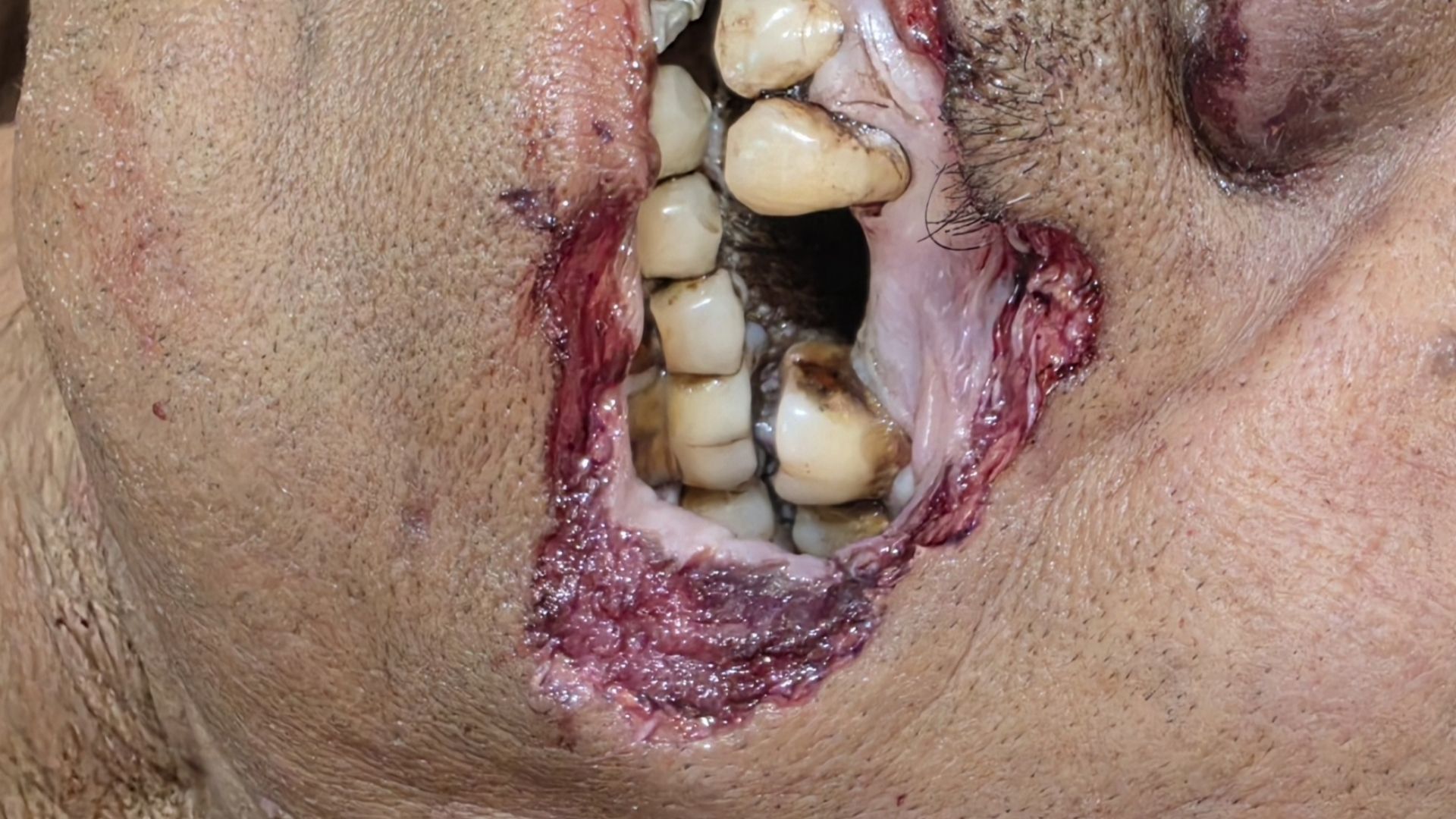 When Postmortem Mimics Trauma: The Forensic Puzzle of Rodent Scavenging