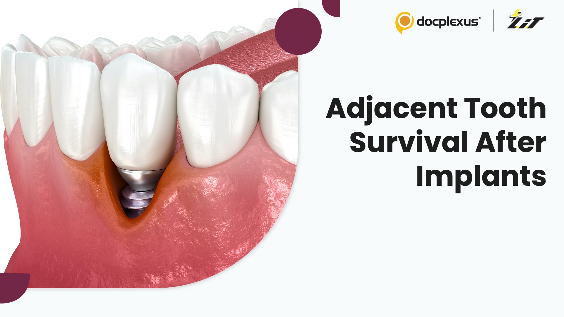 What Happens to Teeth Adjacent to Dental Implants Over Time?