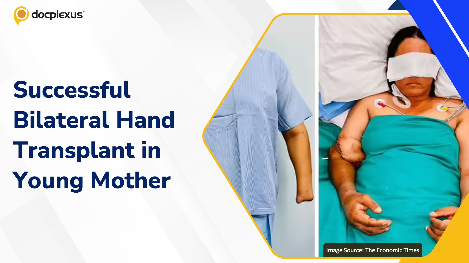 Double Hand Transplant Restores Independence for Young Mother in Delhi