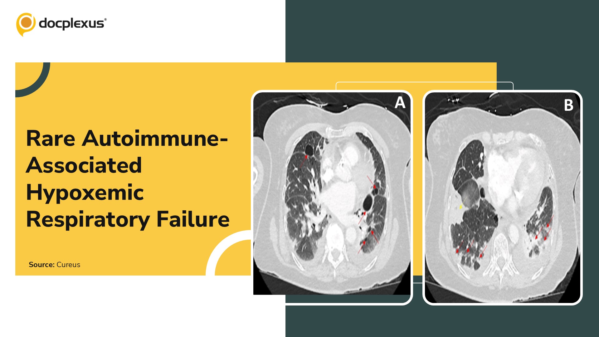 Acute Hypoxemic Respiratory Failure with Progressive Dyspnea in an Elderly Woman with Autoimmune Disease