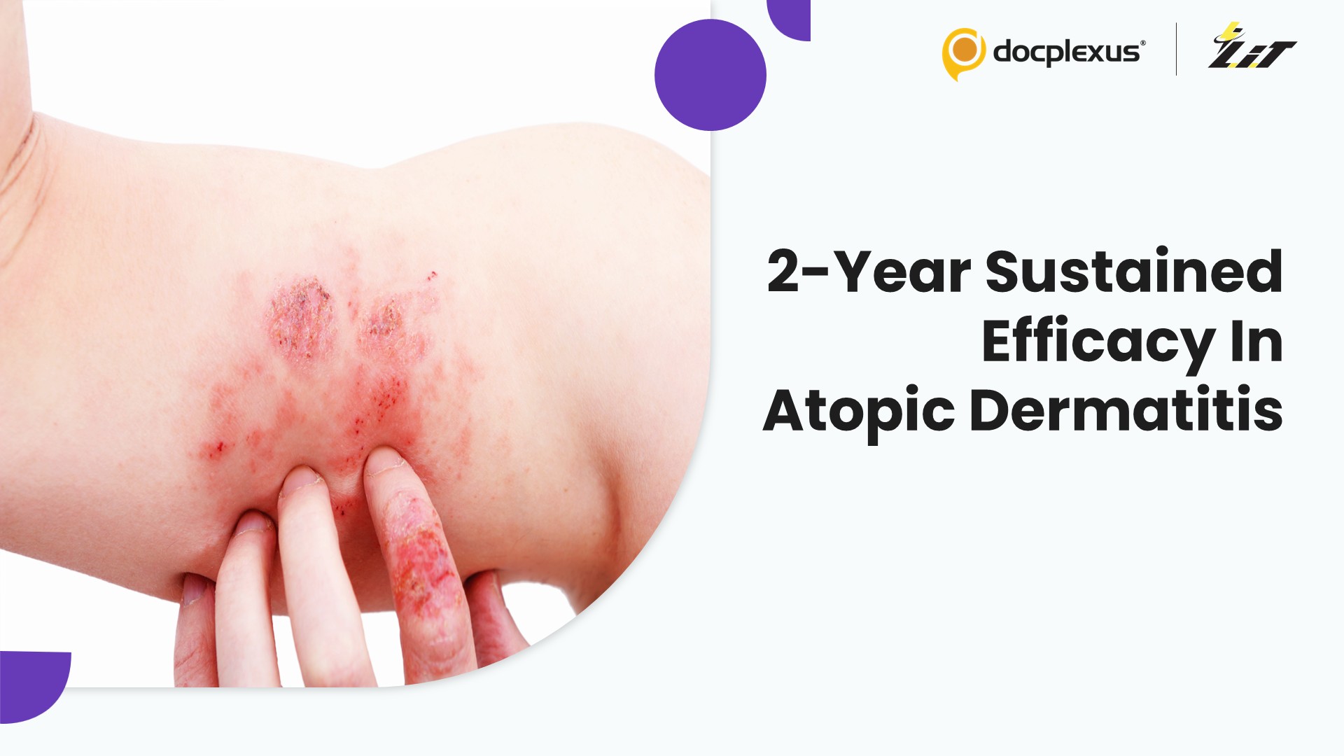 2-Year Abrocitinib Study Highlights Sustained Disease Control in Atopic Dermatitis