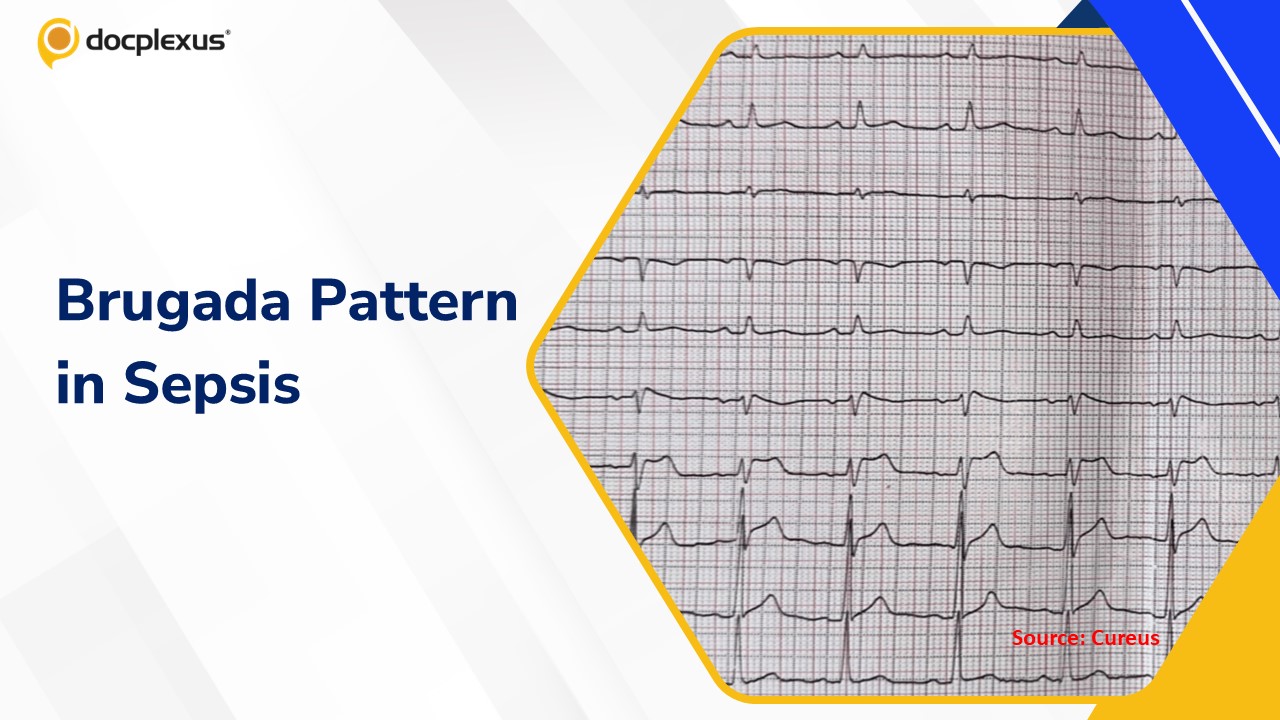Brugada Pattern on ECG in the Setting of Acute Infection: A Diagnostic Challenge