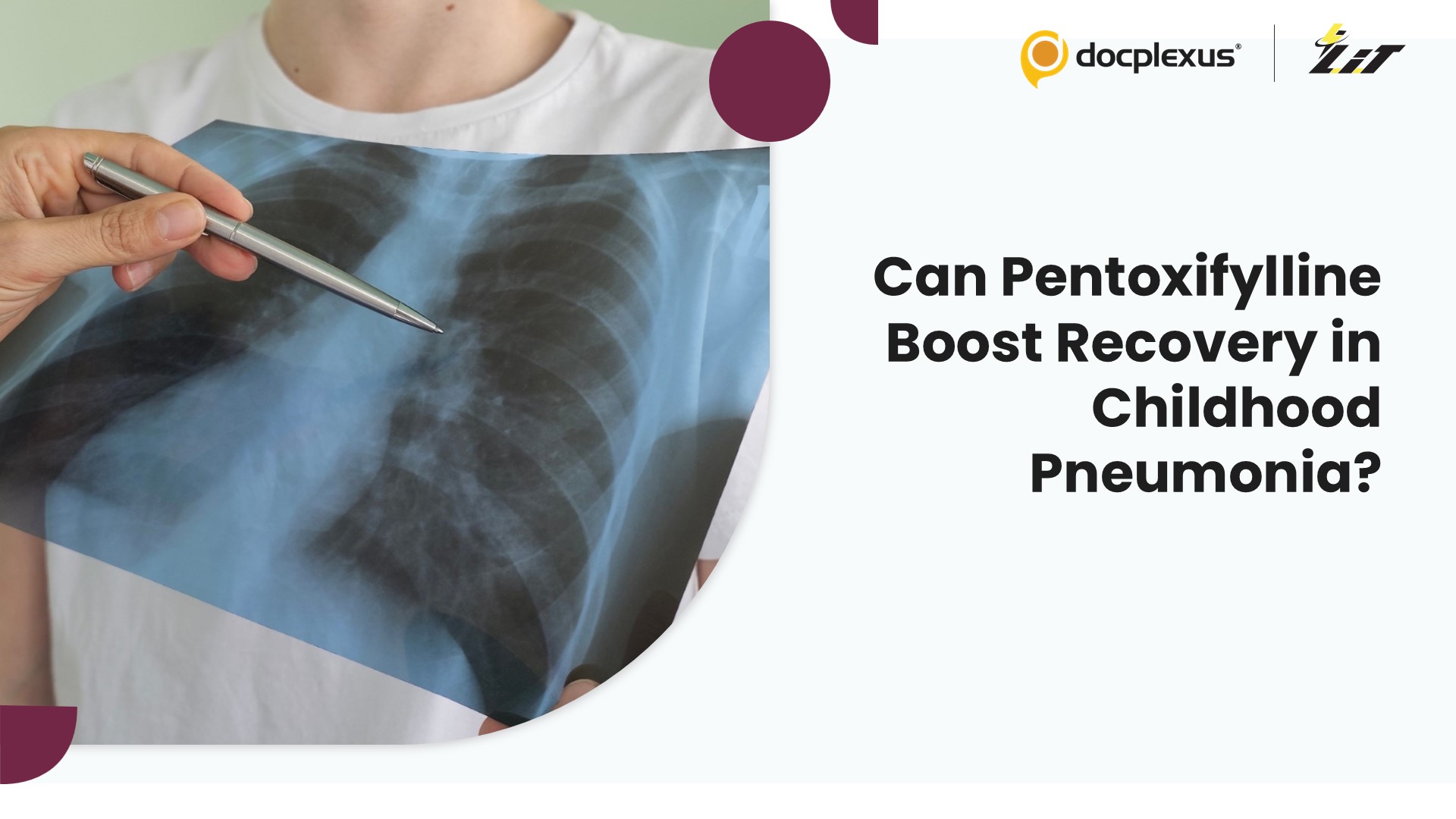 Can Pentoxifylline Improve Recovery in Children Hospitalized with Community-Acquired Pneumonia?