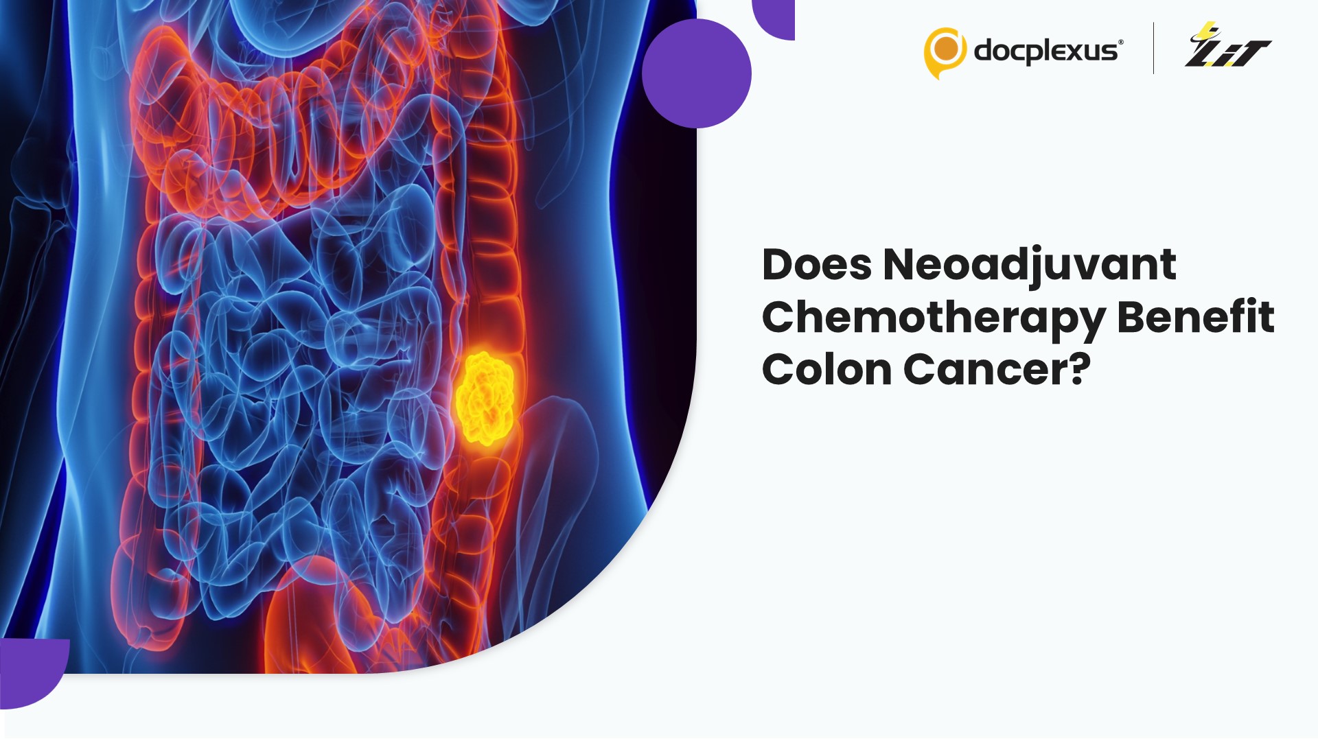 Can Neoadjuvant Chemotherapy Improve Outcomes in Locally Advanced Colon Cancer?