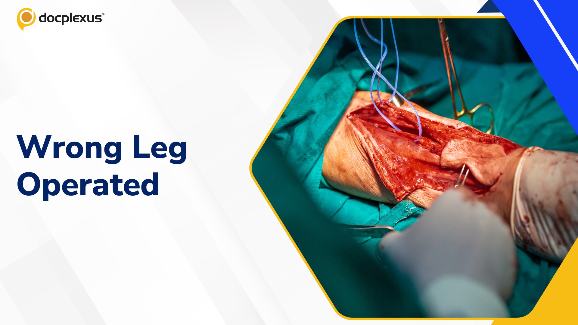 Wrong-Leg Surgery at Jodhpur Hospital Sparks Safety Probe