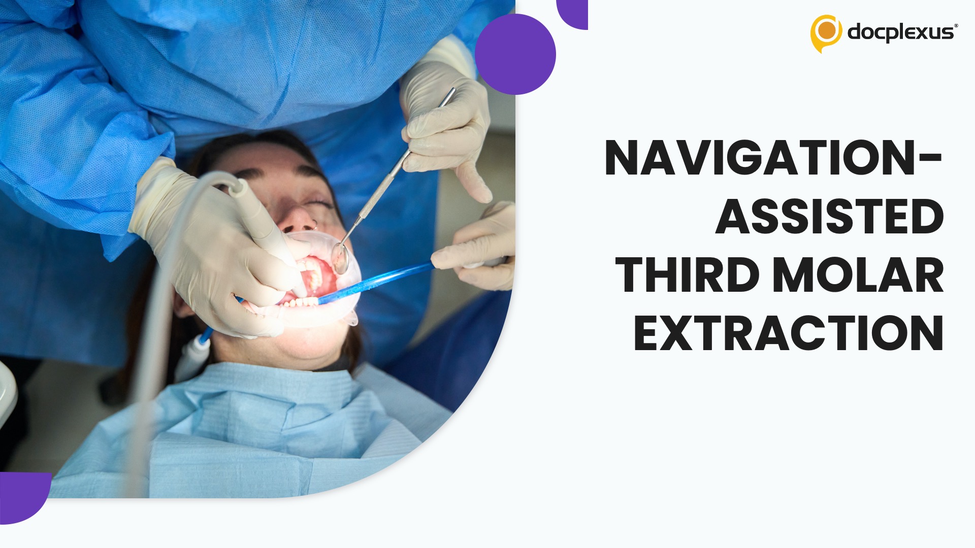 Third Molar Surgery Meets Navigation: Precision Upgrade or Selective Tool?