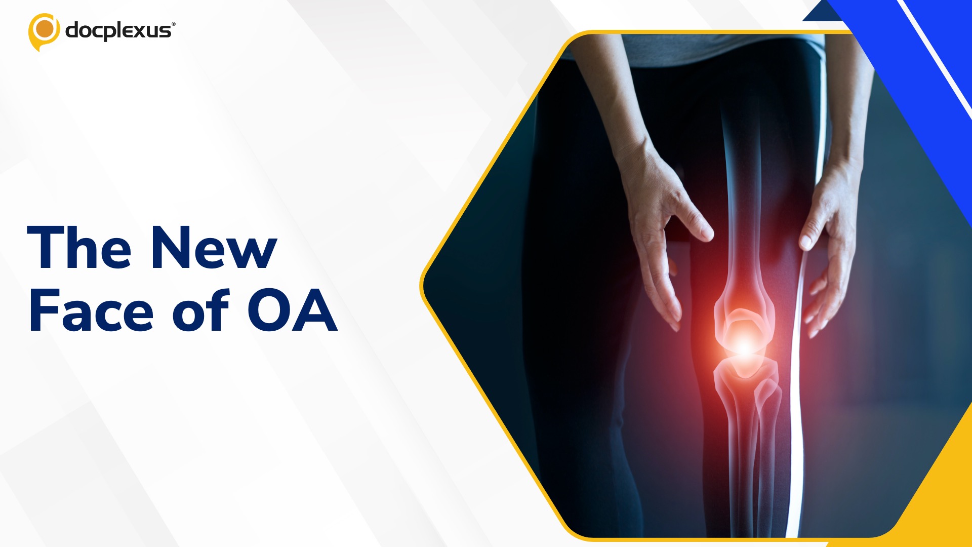 Rising Osteoarthritis Rates in Younger Adults Highlight Need for Personalized Care