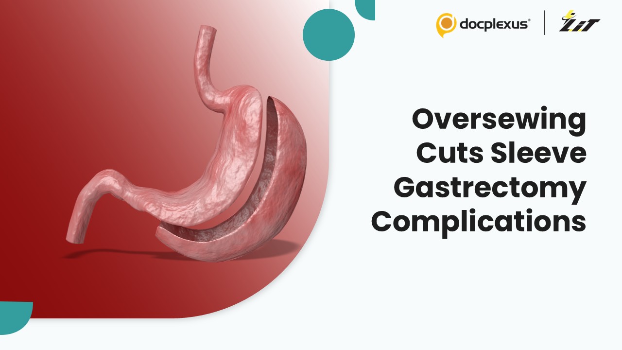 Staple Line Oversewing Significantly Reduces Postoperative Complications After Sleeve Gastrectomy