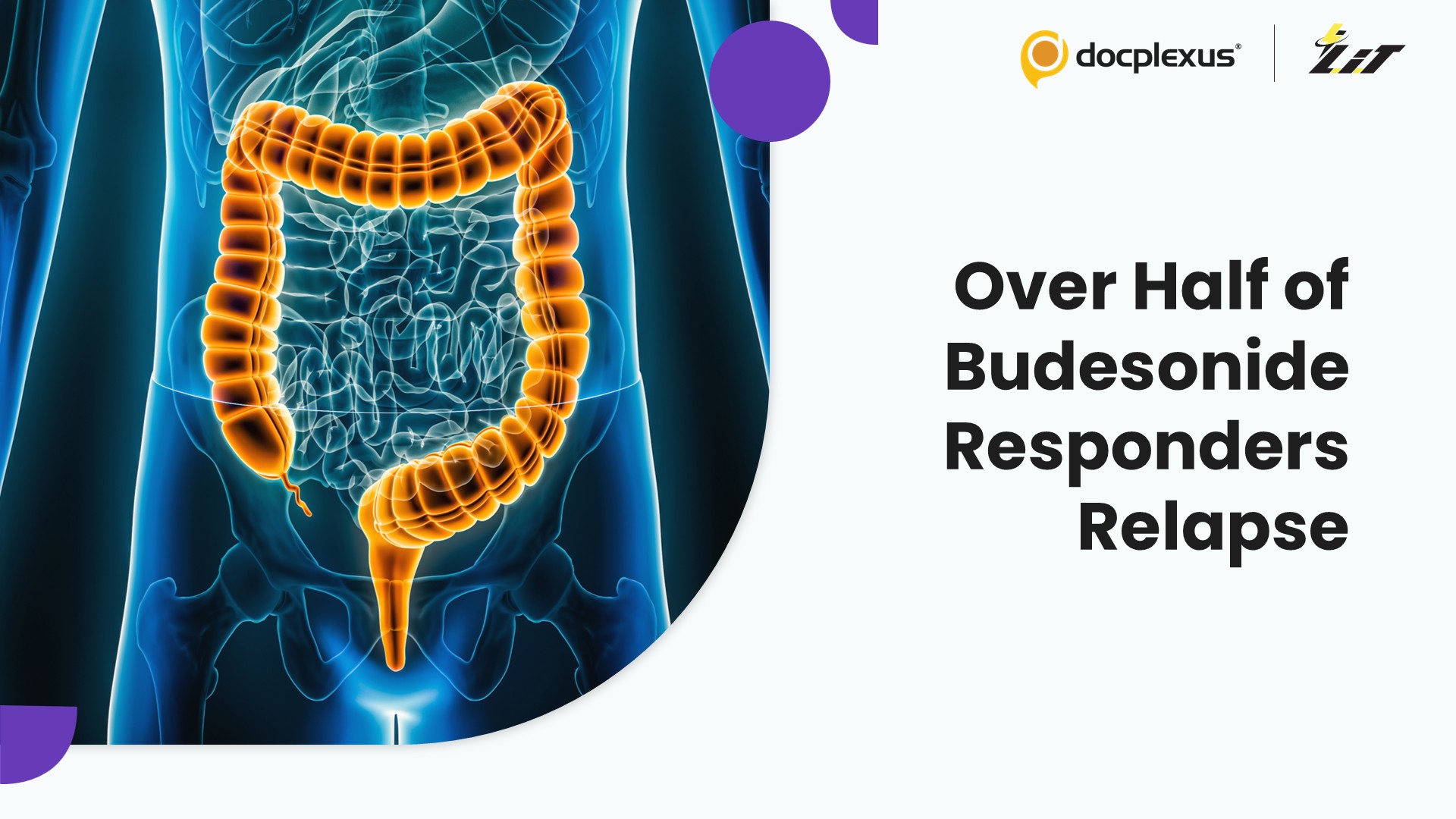 High Relapse Rates After Budesonide Highlight the Need for Advanced Therapies in Microscopic Colitis