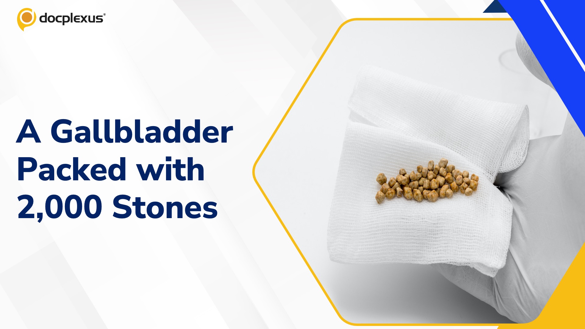 Rare Surgical Case Reveals Nearly 2,000 Gallstones in an 83-Year-Old