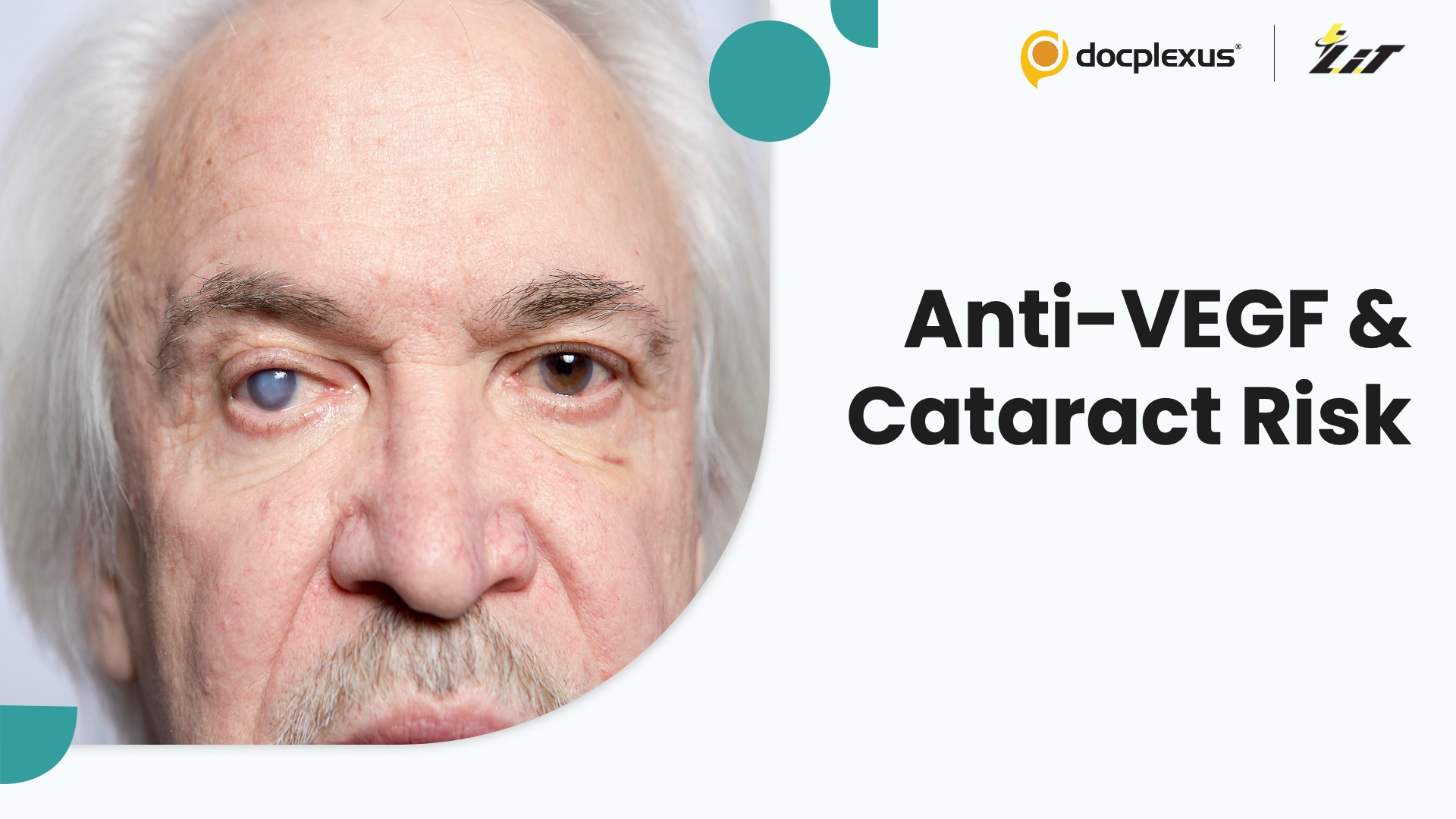 Do Repeated Anti-VEGF Injections Increase Cataract Surgery Risk?