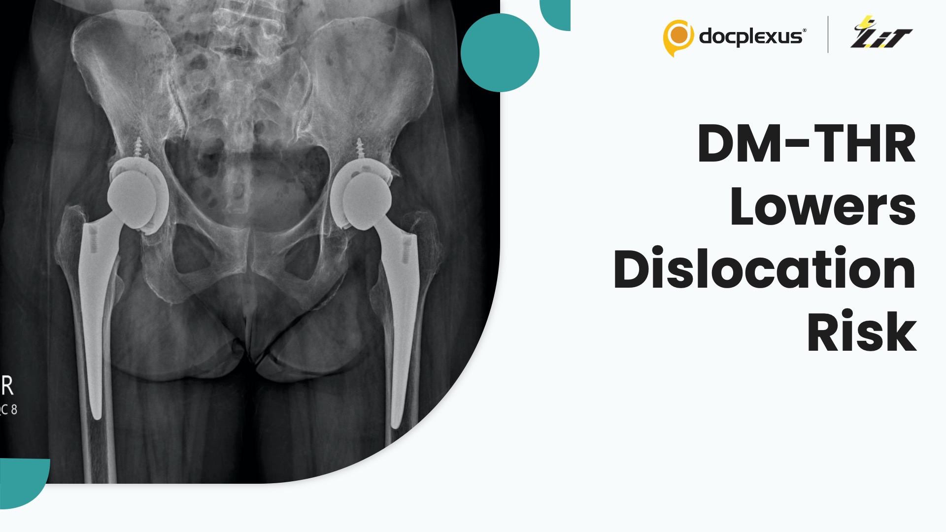 Dual Mobility THR Cuts Hip Dislocation Risk in Fracture Patients