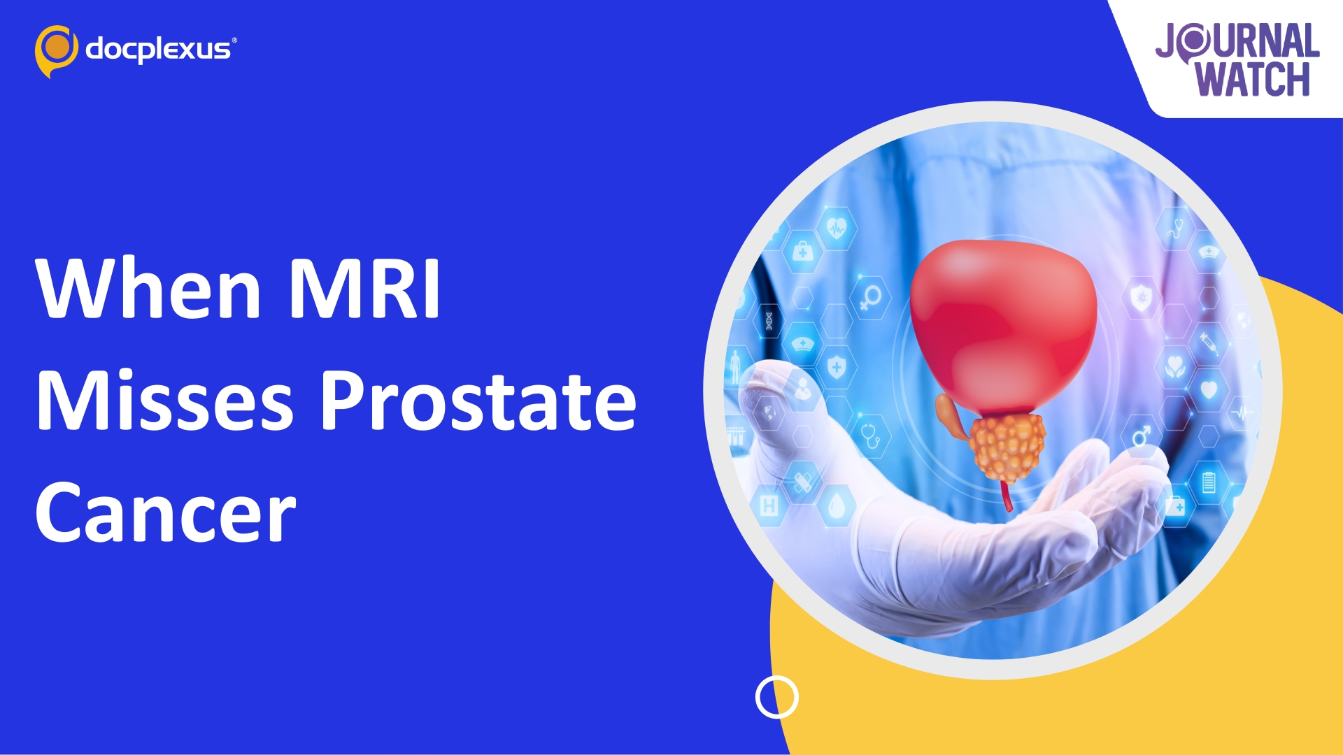 Negative Prostate MRI Does Not Always Rule Out Significant Cancer