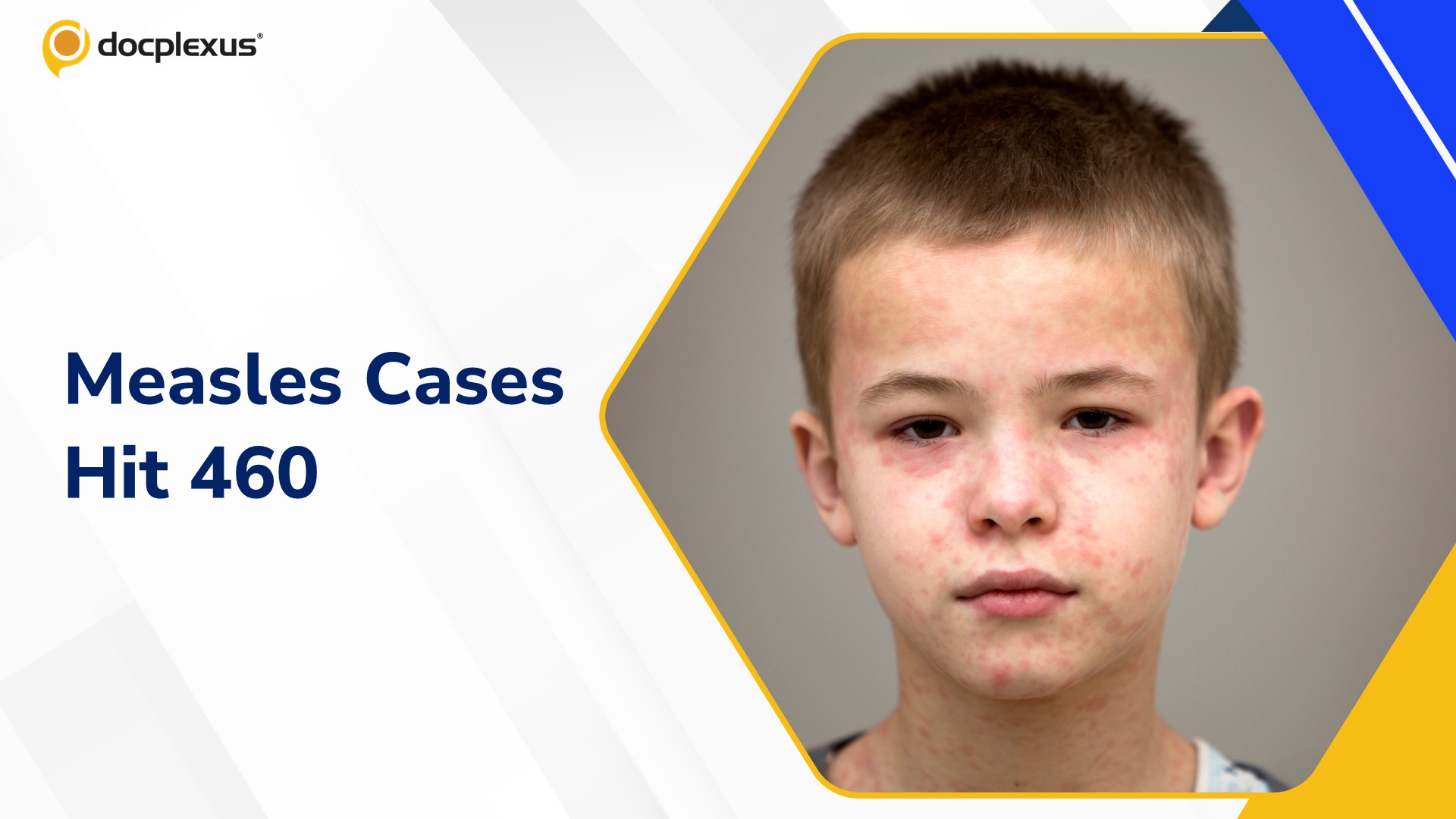 Measles Cases in Pennsylvania Reach 460 Amid Ongoing Outbreak