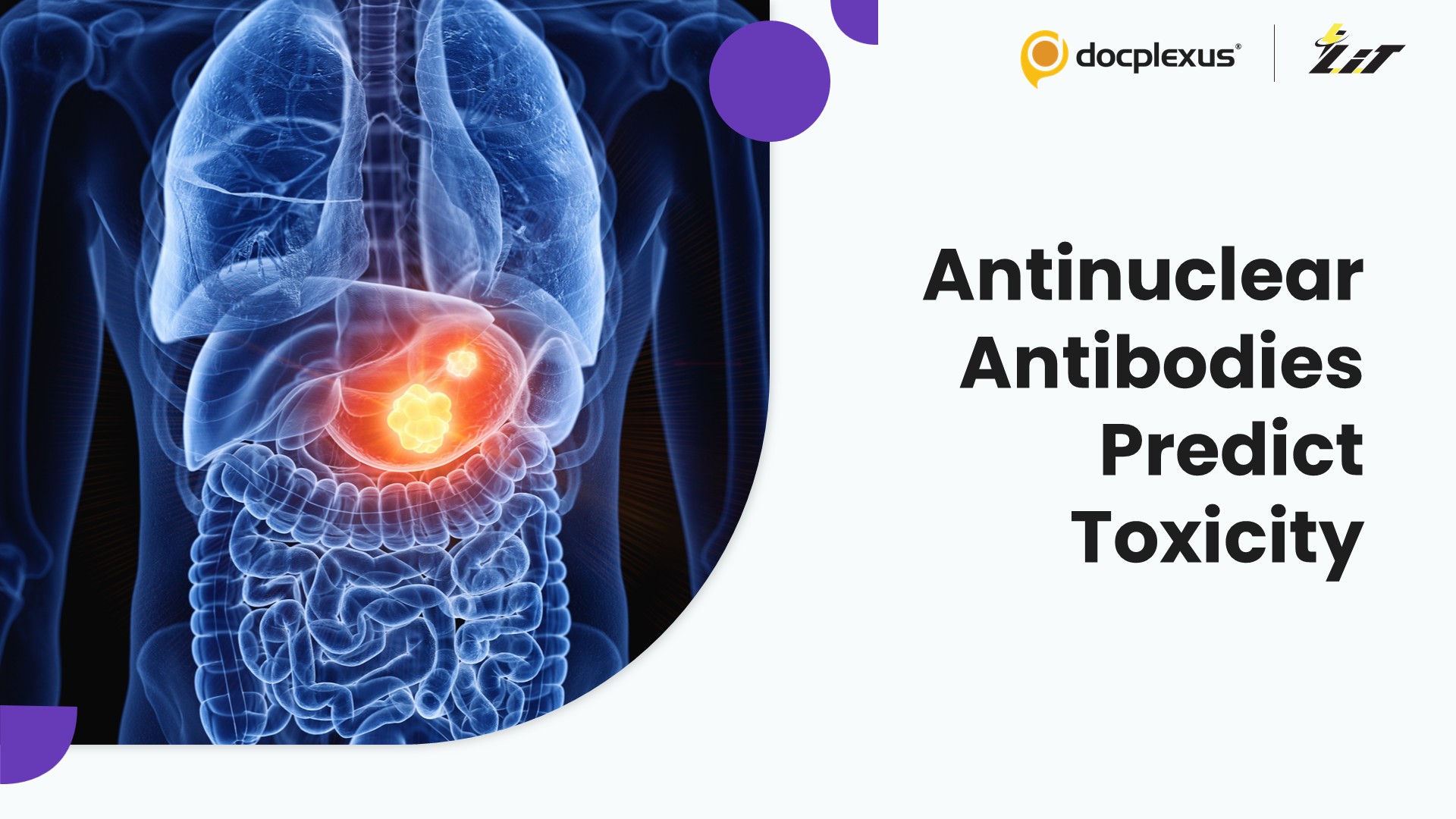 High Antinuclear Antibody Titers Predict Severe Toxicity in Gastric Cancer Immunotherapy