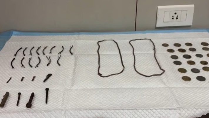 23 Coins, a Nail Cutter and More Removed From Teenager’s Stomach