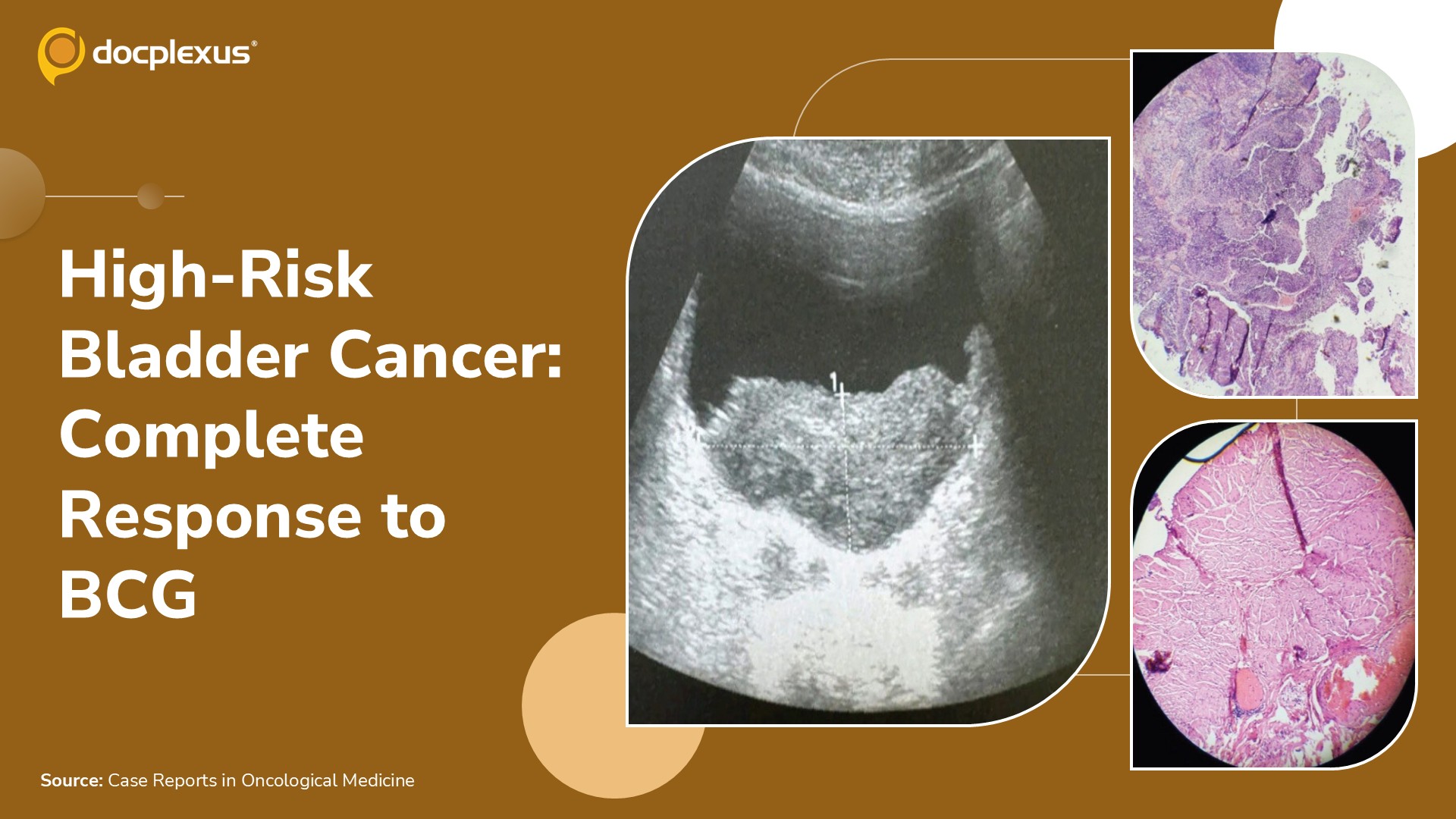 When High-Risk Bladder Cancer Responds to Bladder-Preserving Therapy
