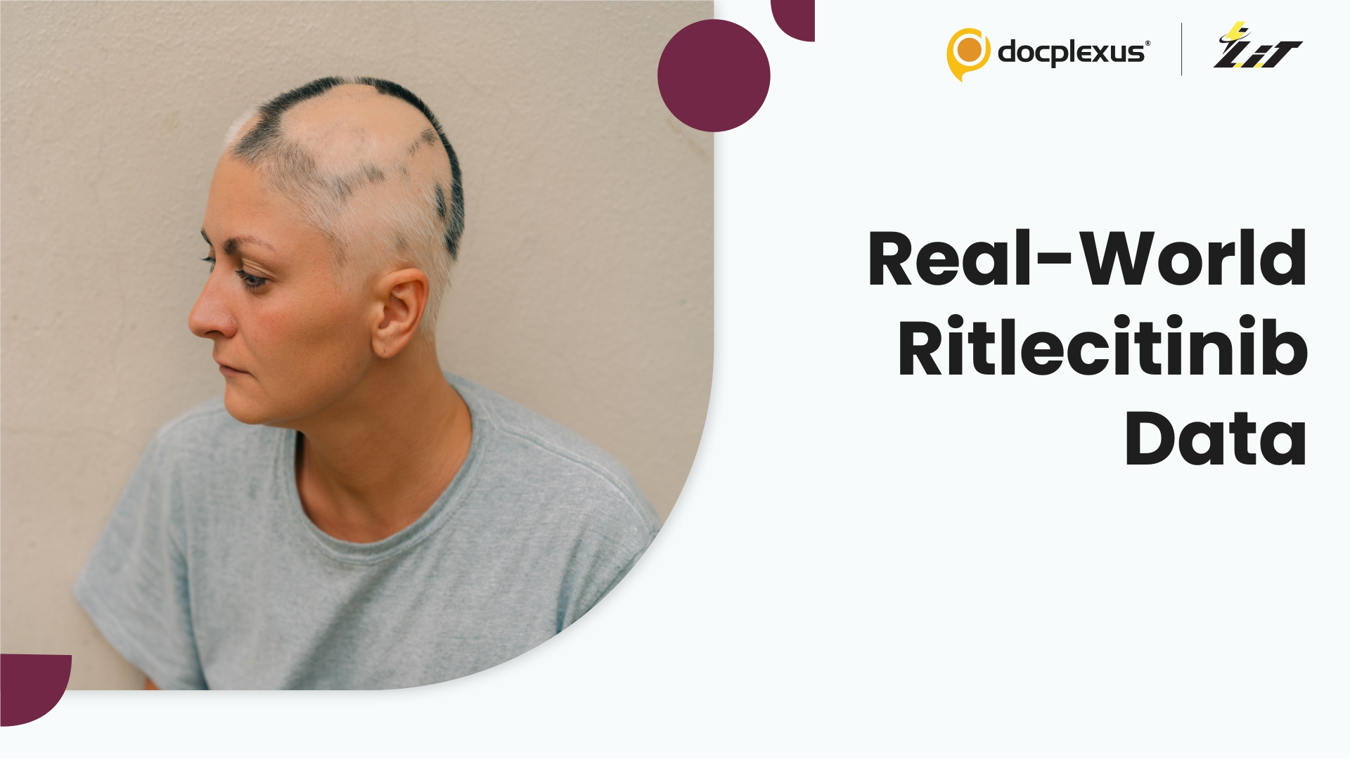 Ritlecitinib Shows Real-World Efficacy in Severe Alopecia Areata