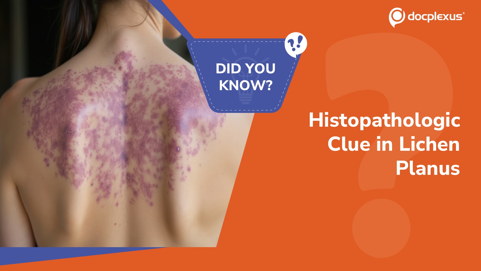 Which Histopathologic Finding is Characteristic of Lichen Planus?