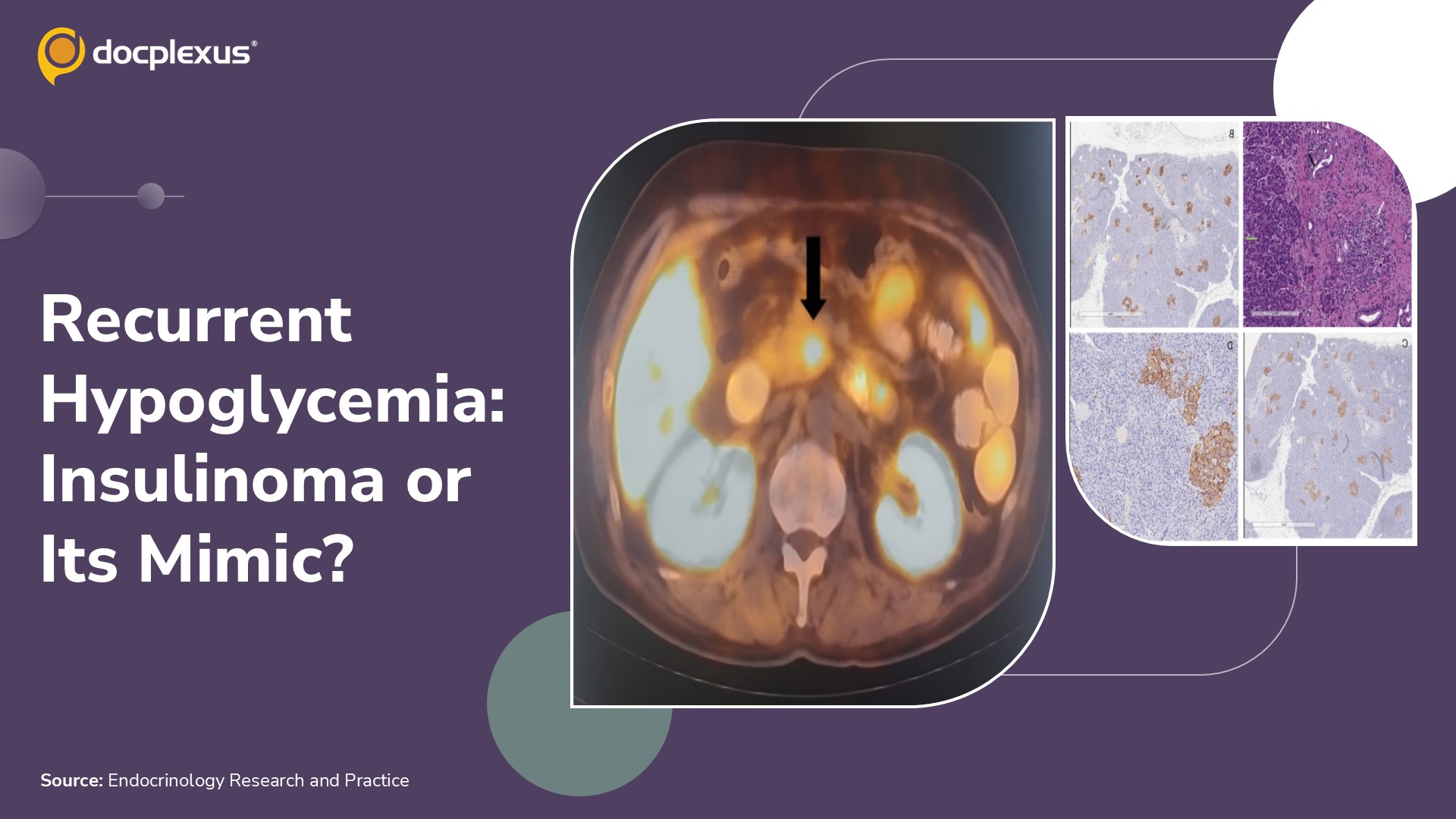 When Hypoglycemia Mimics a Pancreatic Tumor