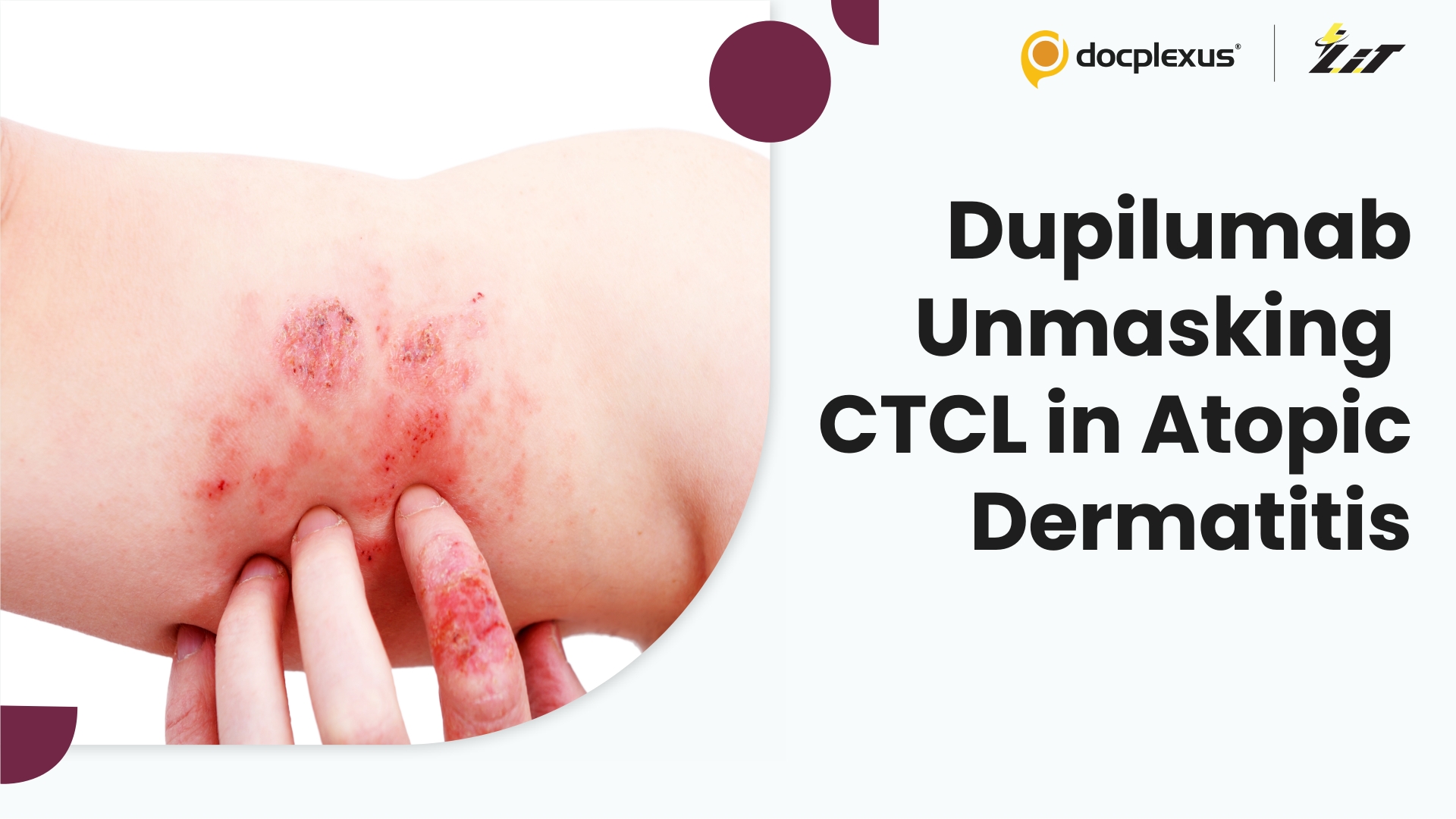 Consensus Recommendations for CTCL in Patients With Atopic Dermatitis Receiving Dupilumab