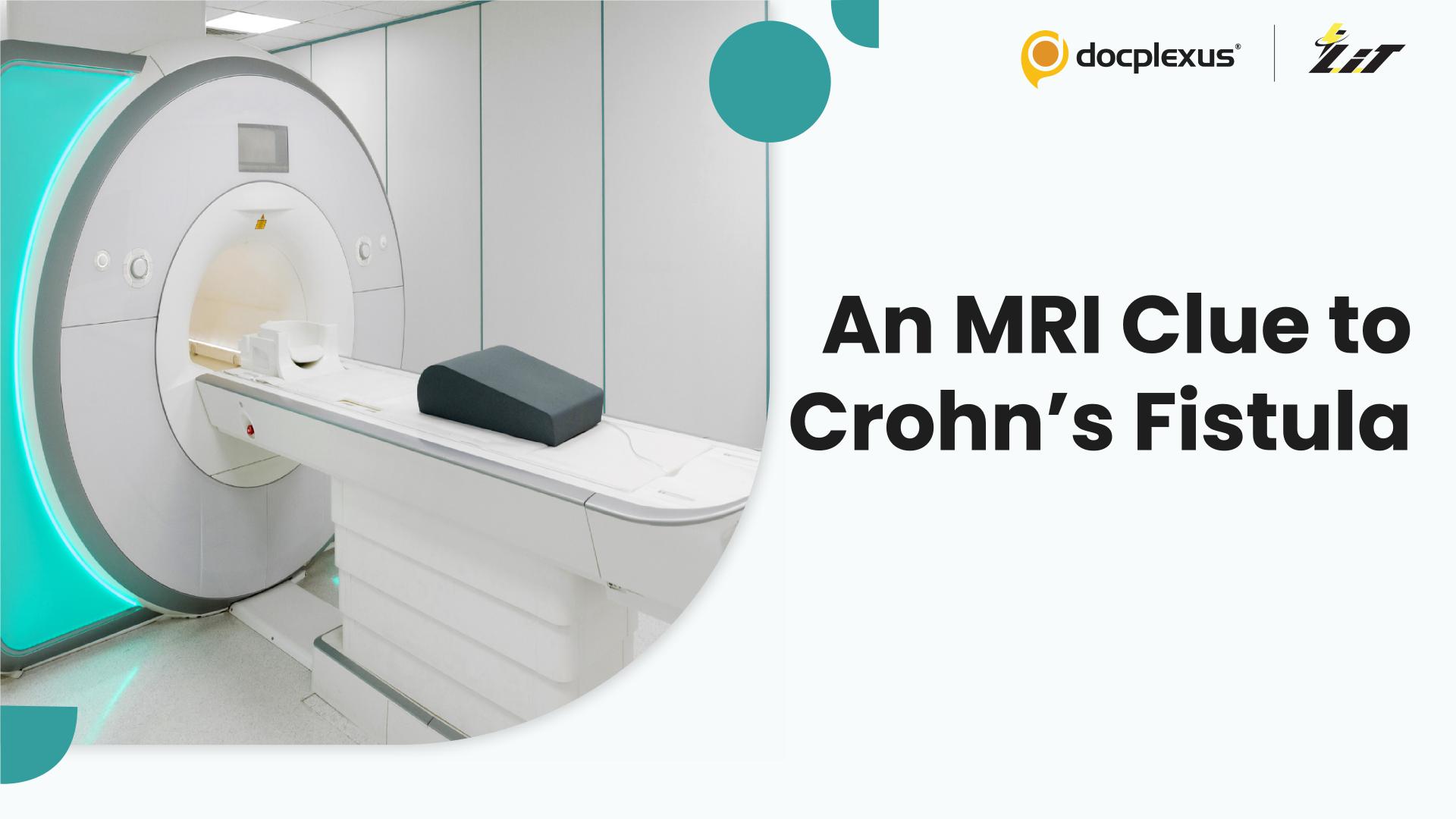 Could MRI Distinguish Crohn’s-Related Fistulas?