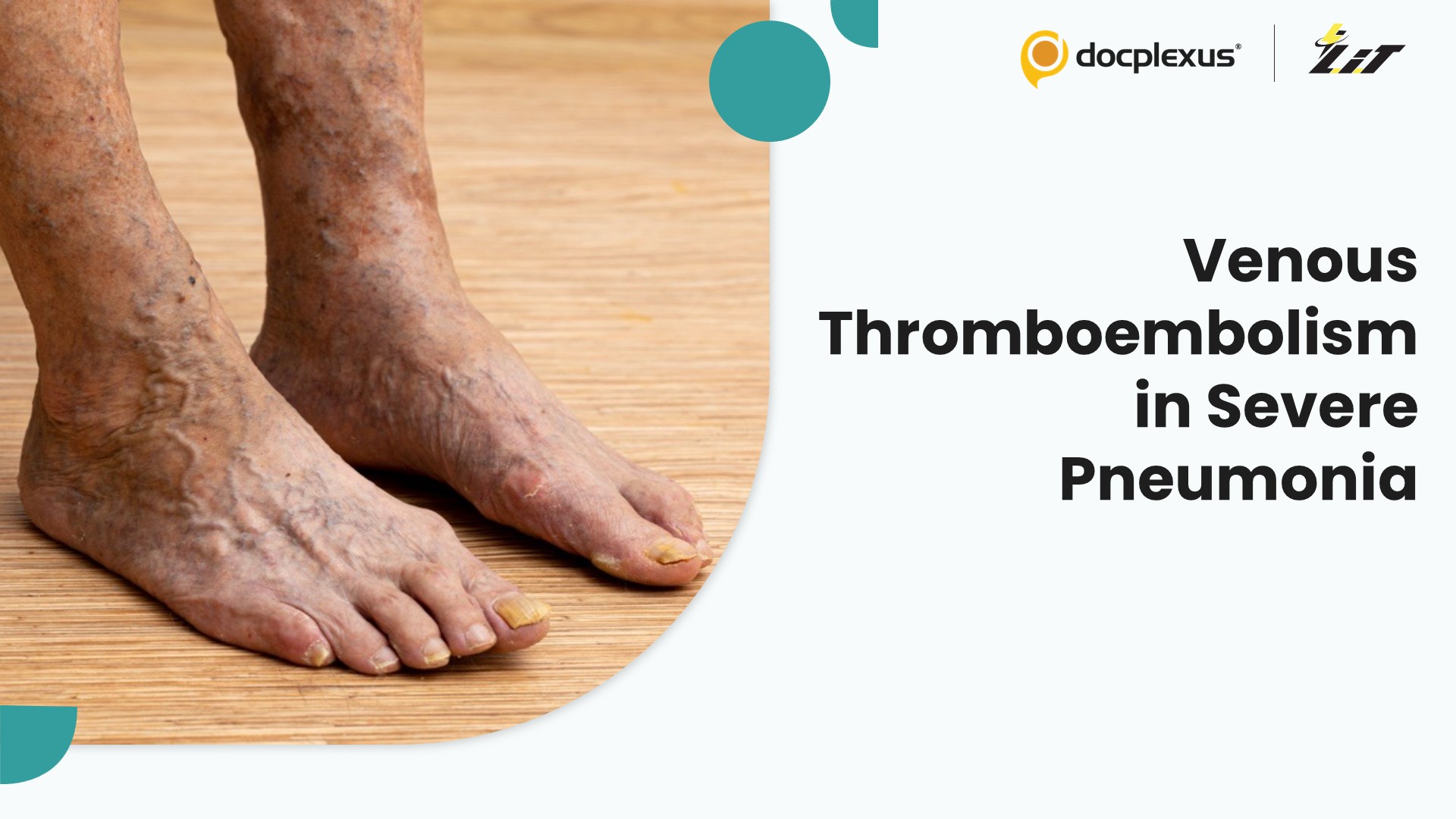 Venous Thromboembolism in Severe Community-Acquired Pneumonia at High-Altitude Areas