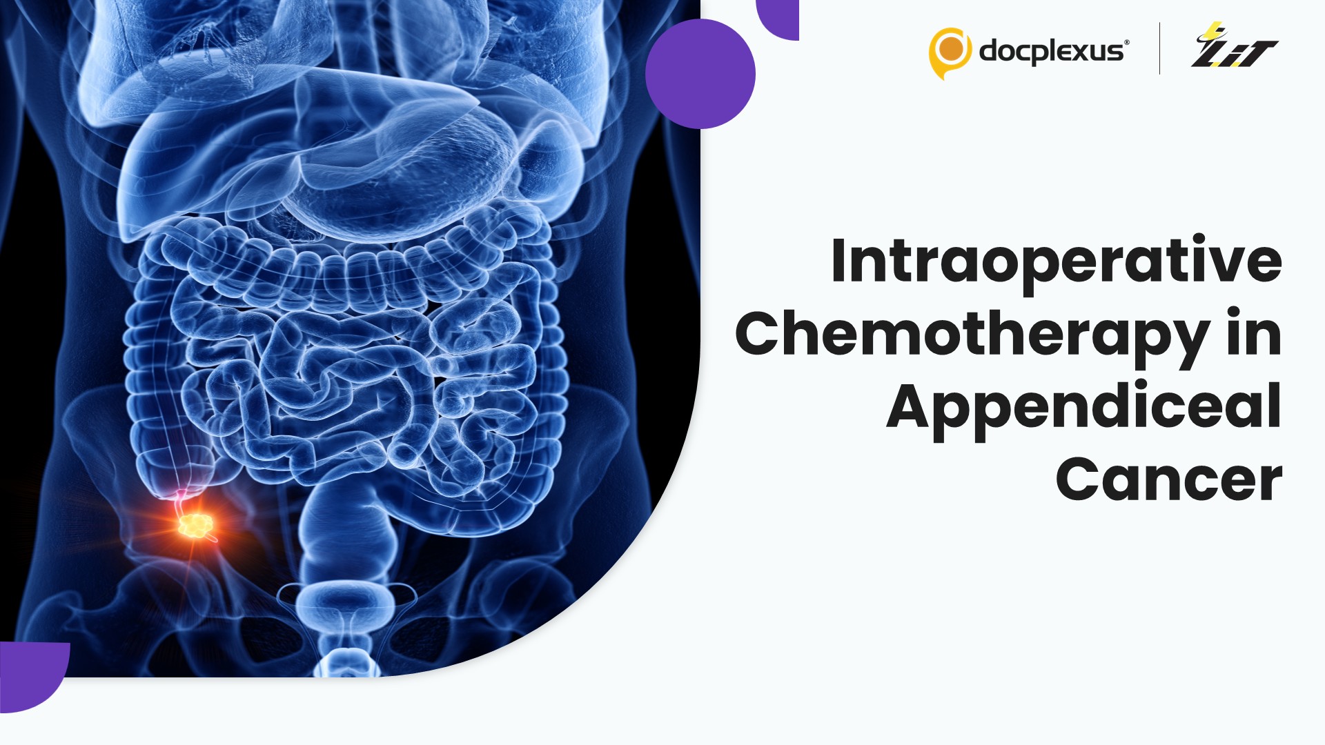 Intraoperative Systemic Chemotherapy in Stage II–III Appendiceal Adenocarcinoma