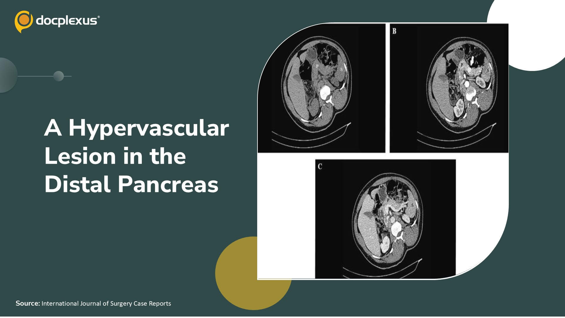 Recurrent Fasting Hypoglycemia With a Hypervascular Pancreatic Lesion