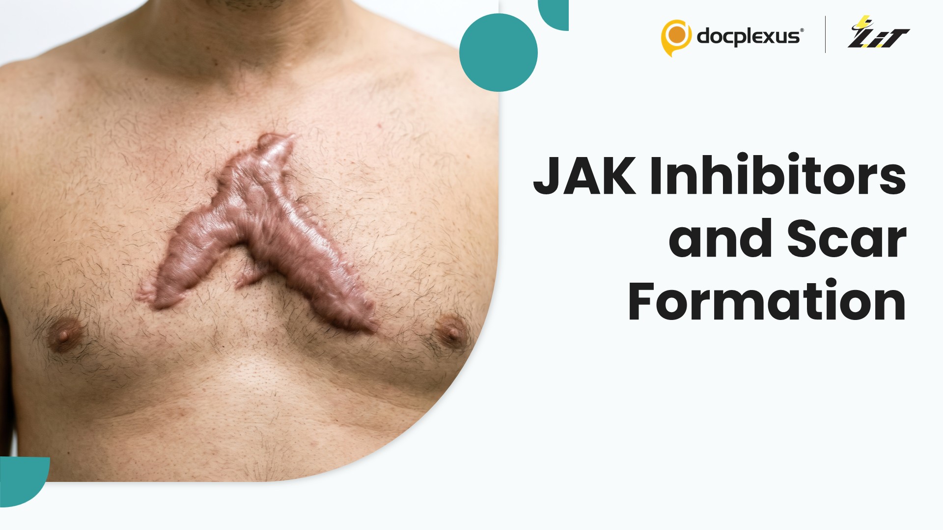 JAK/STAT Inhibitors Reduce Risk of New-Onset Keloids and Hypertrophic Scars