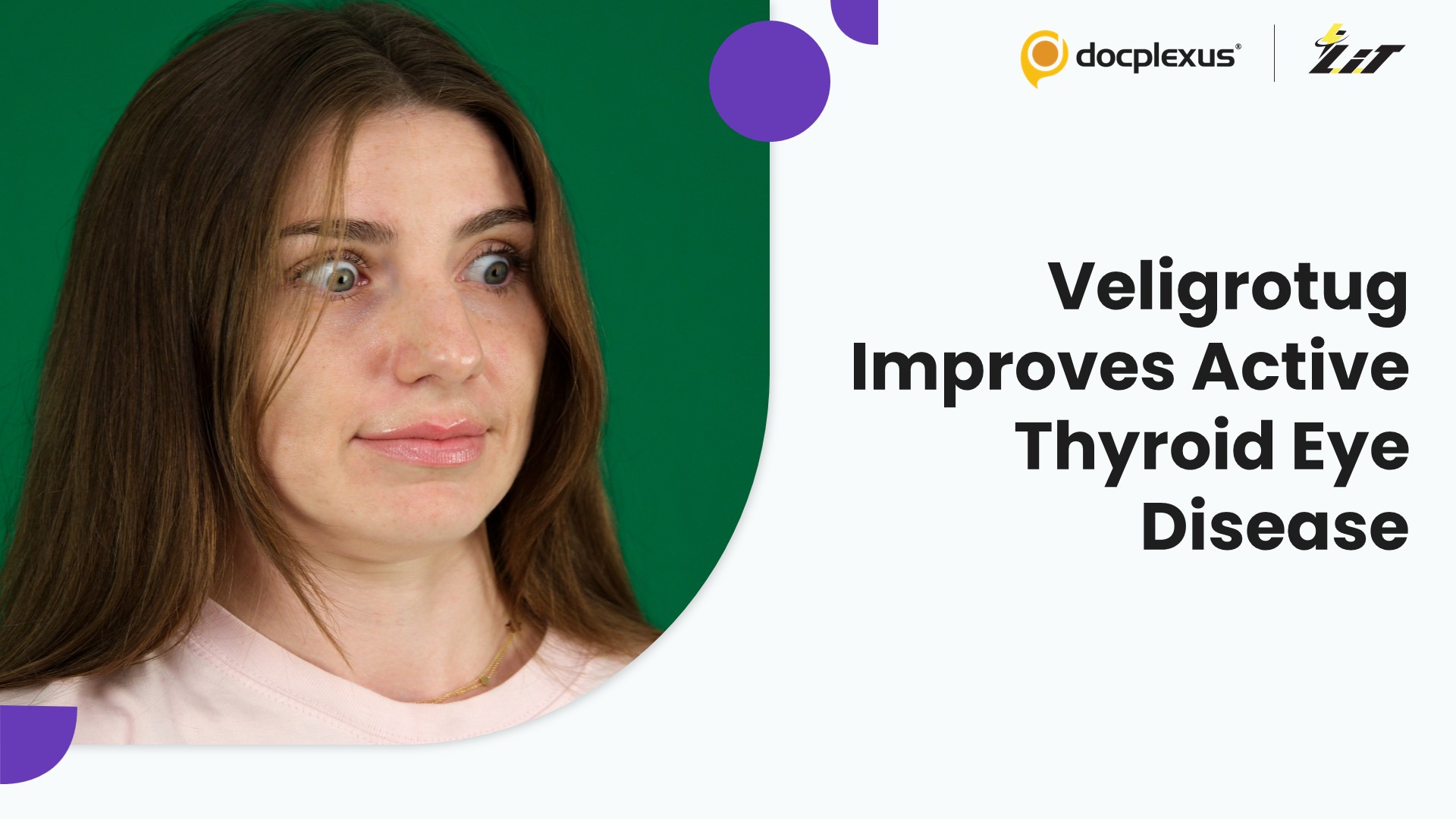 Veligrotug Improved Proptosis, Diplopia, and Disease Activity in Active Thyroid Eye Disease