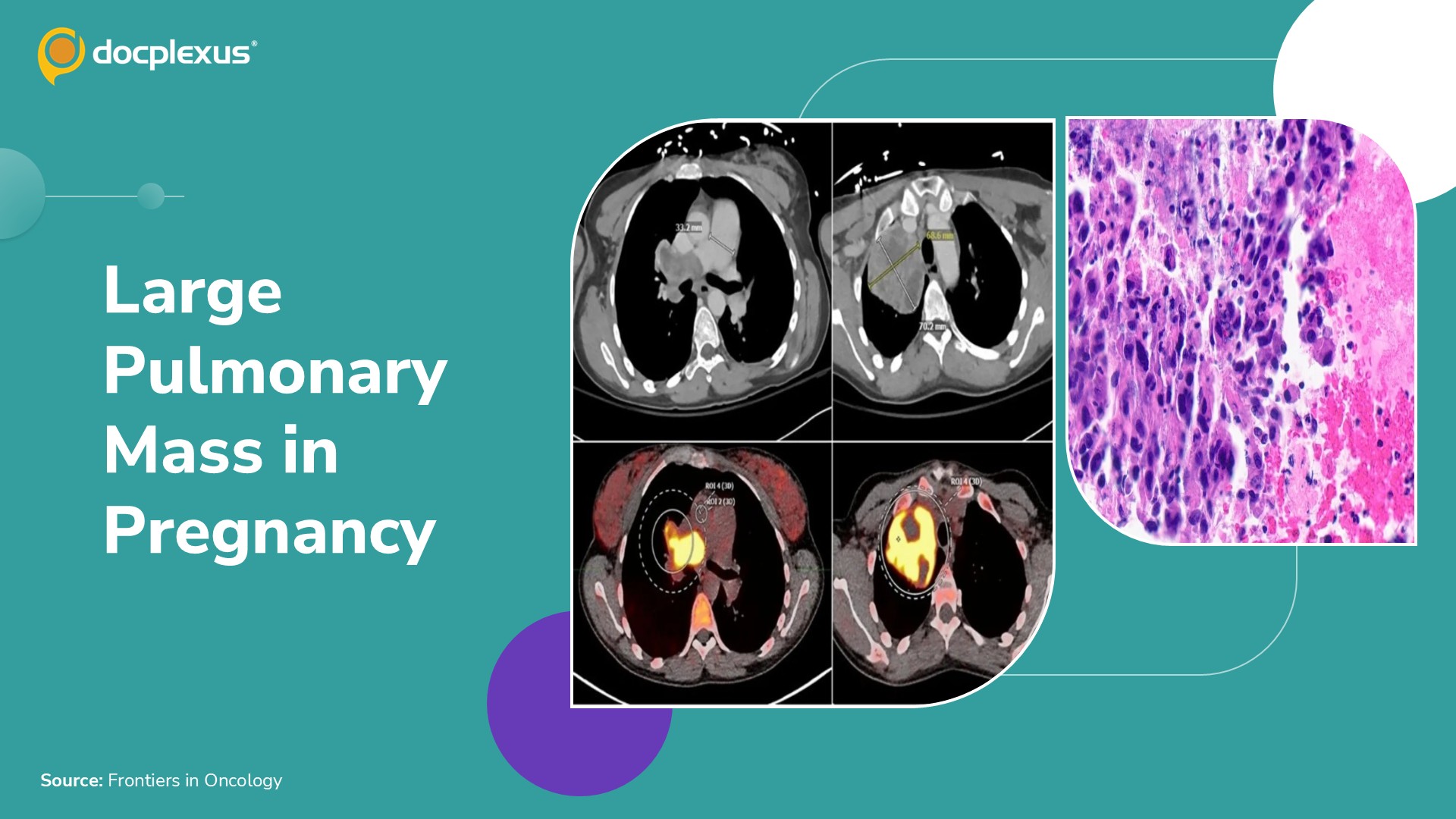 A Large Pulmonary Mass in Pregnancy: What Is the Diagnosis?
