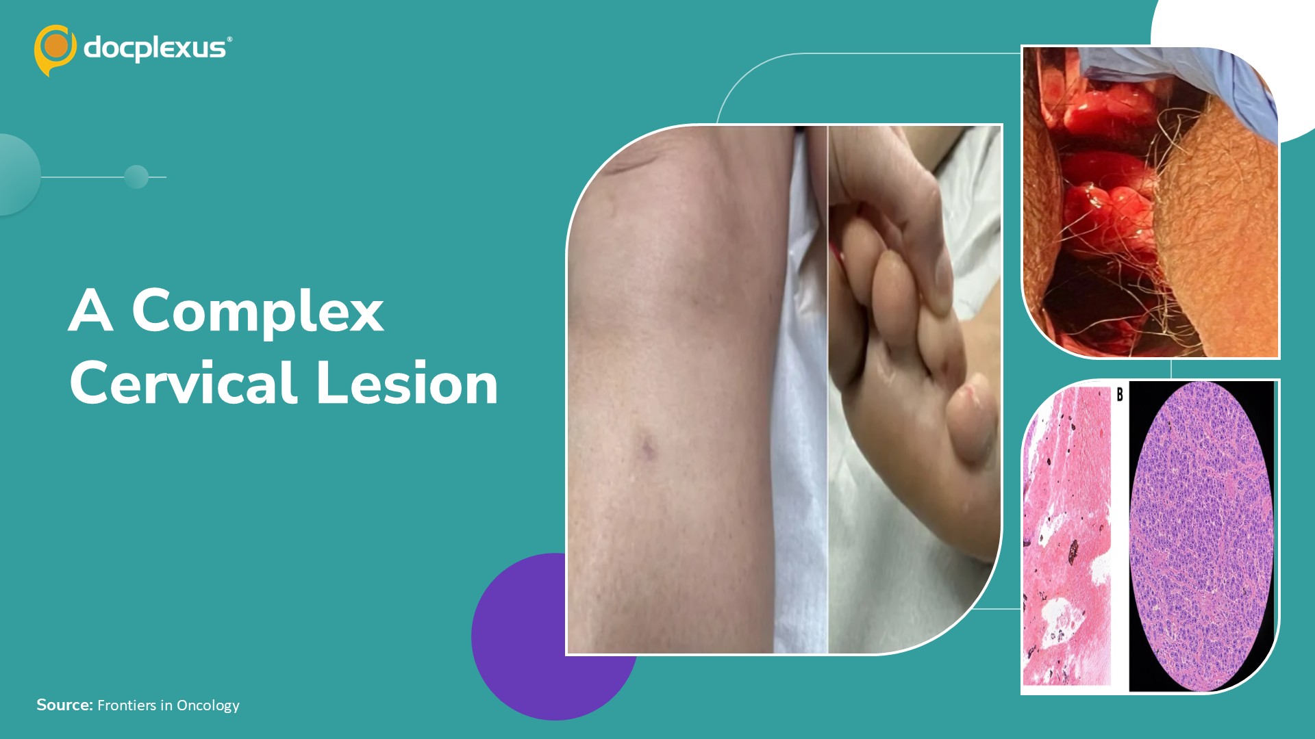 Diagnose This Unusual Cervical Lesion with Early Recurrence