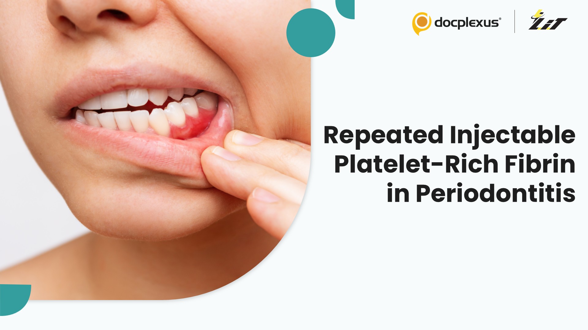 Repeated Injectable Platelet-Rich Fibrin as an Adjunct to Periodontitis Treatment