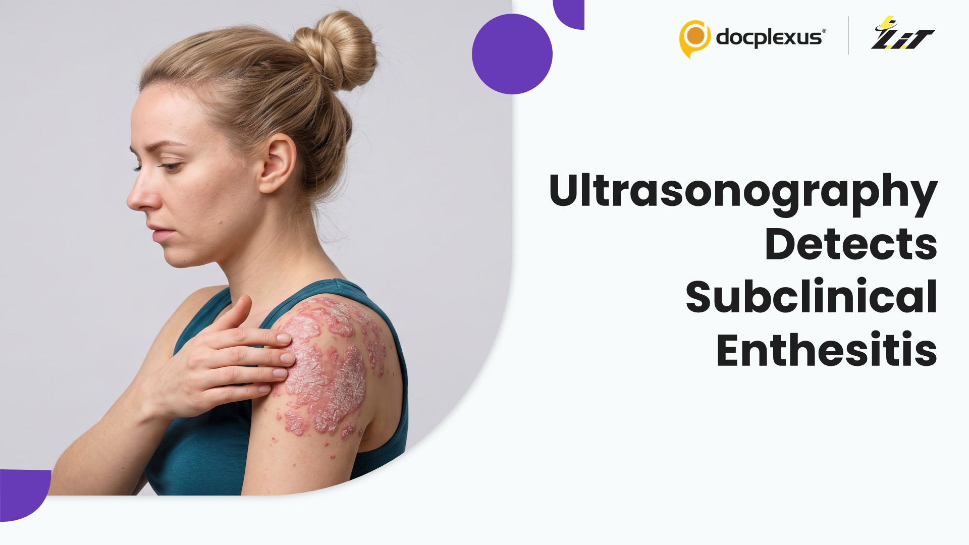 Subclinical Enthesitis Detected by Ultrasonography in Chronic Plaque Psoriasis